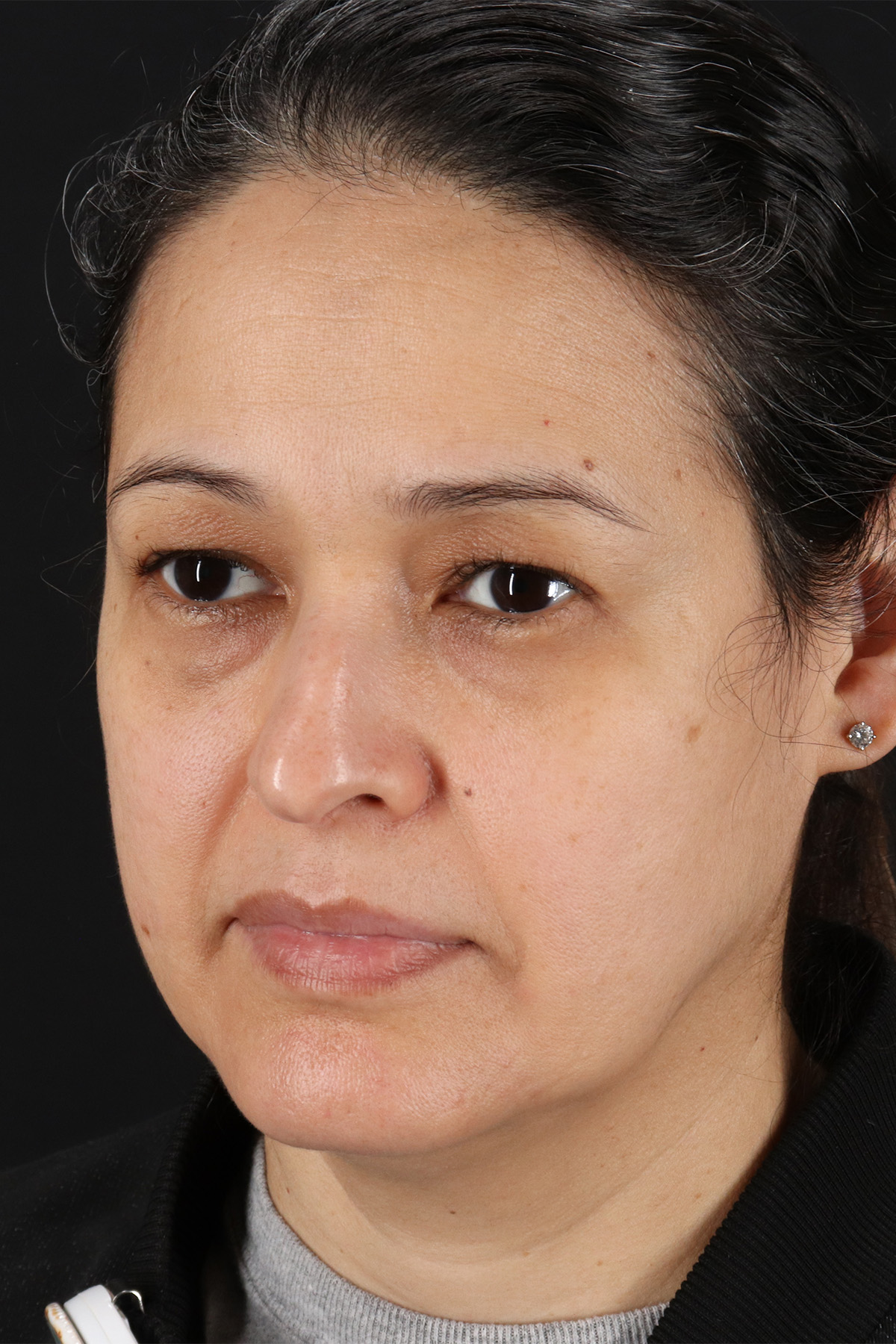 Upper Blepharoplasty Before & After Patient #12018