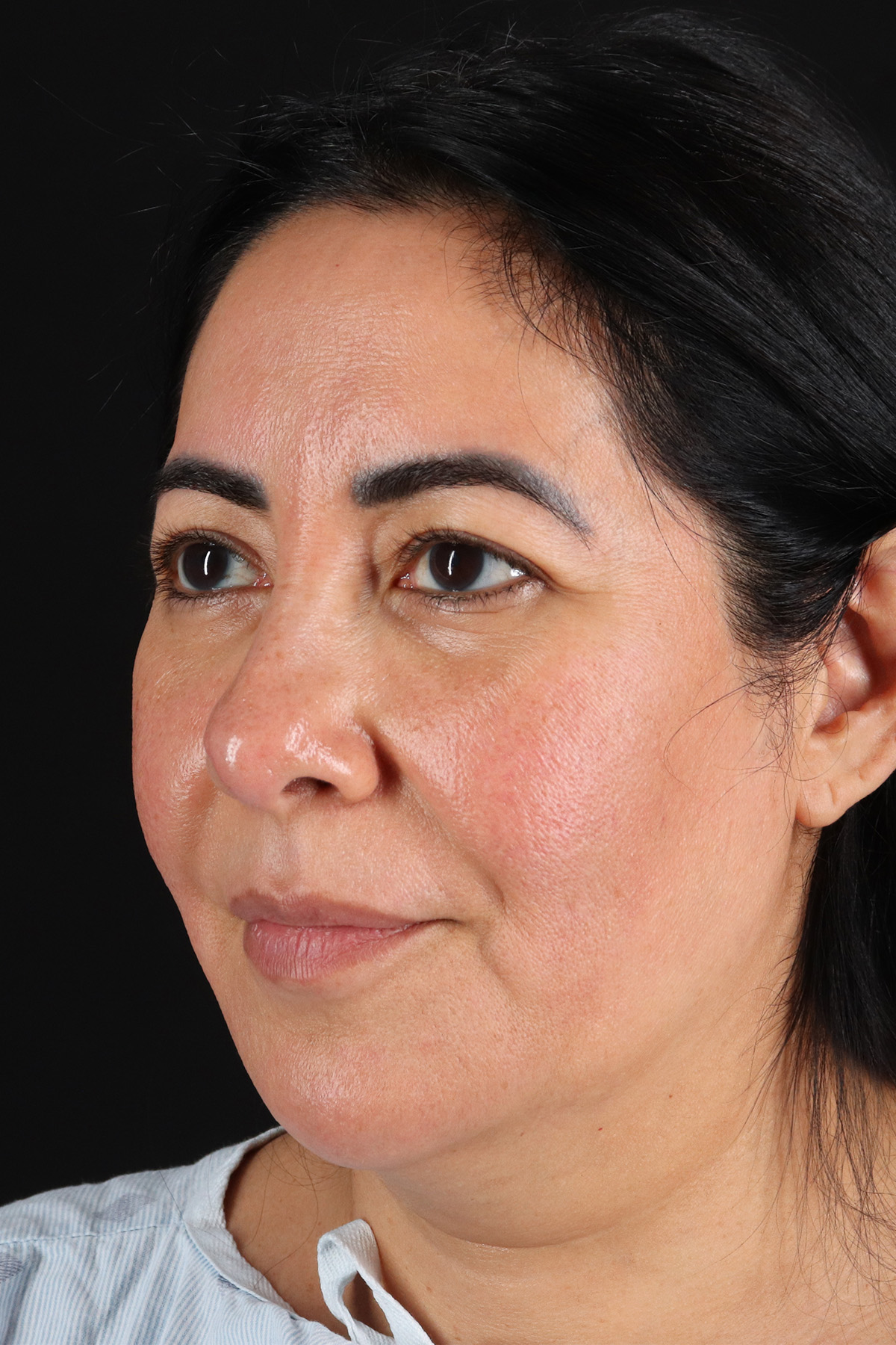 Upper Blepharoplasty Before & After Patient #12062