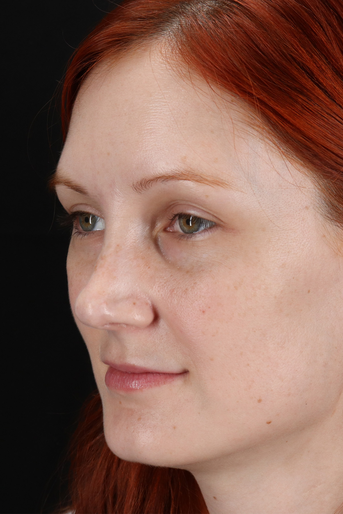 Lower Blepharoplasty Before & After Patient #13008
