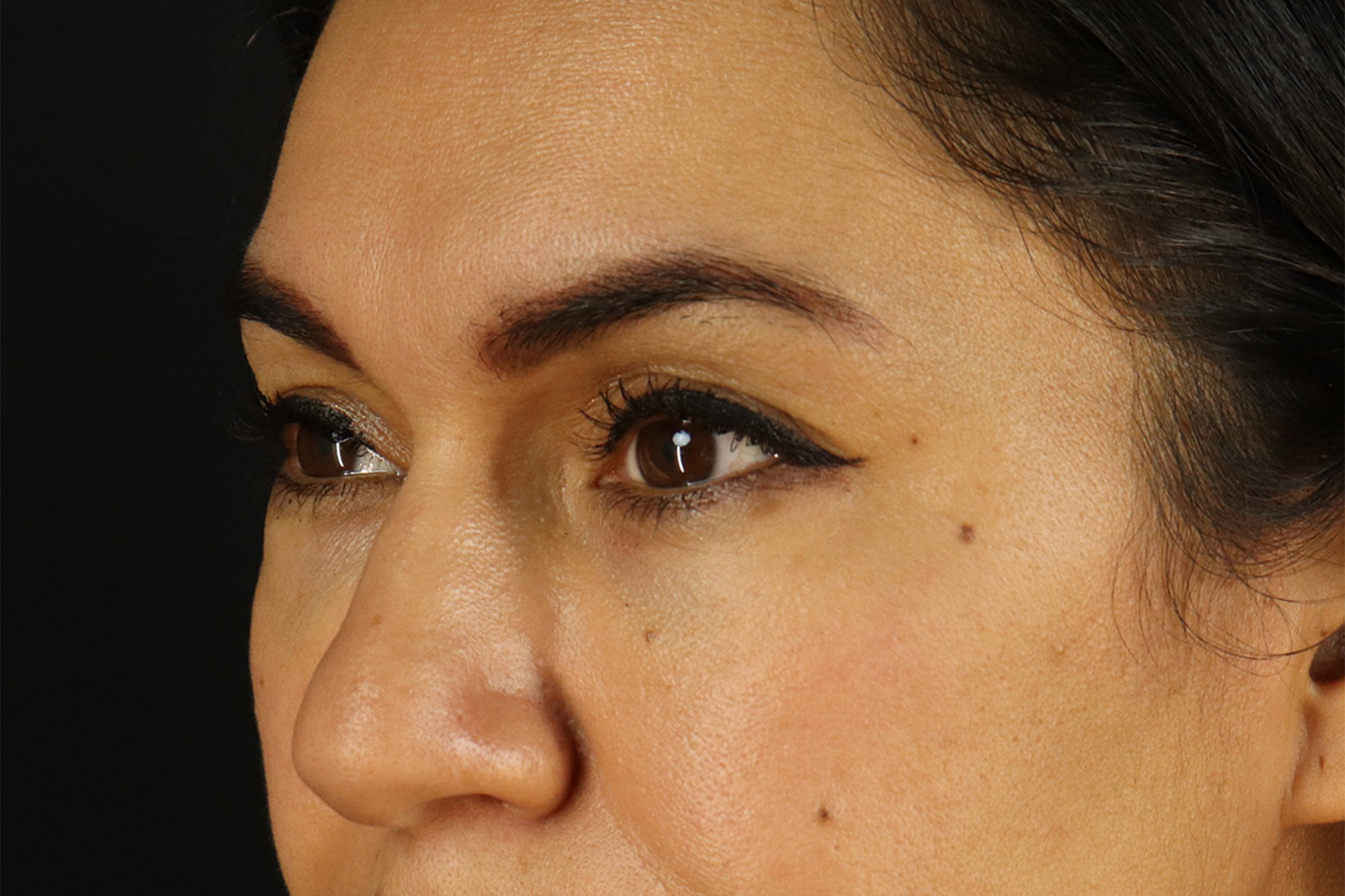 Upper Blepharoplasty Before & After Patient #12007