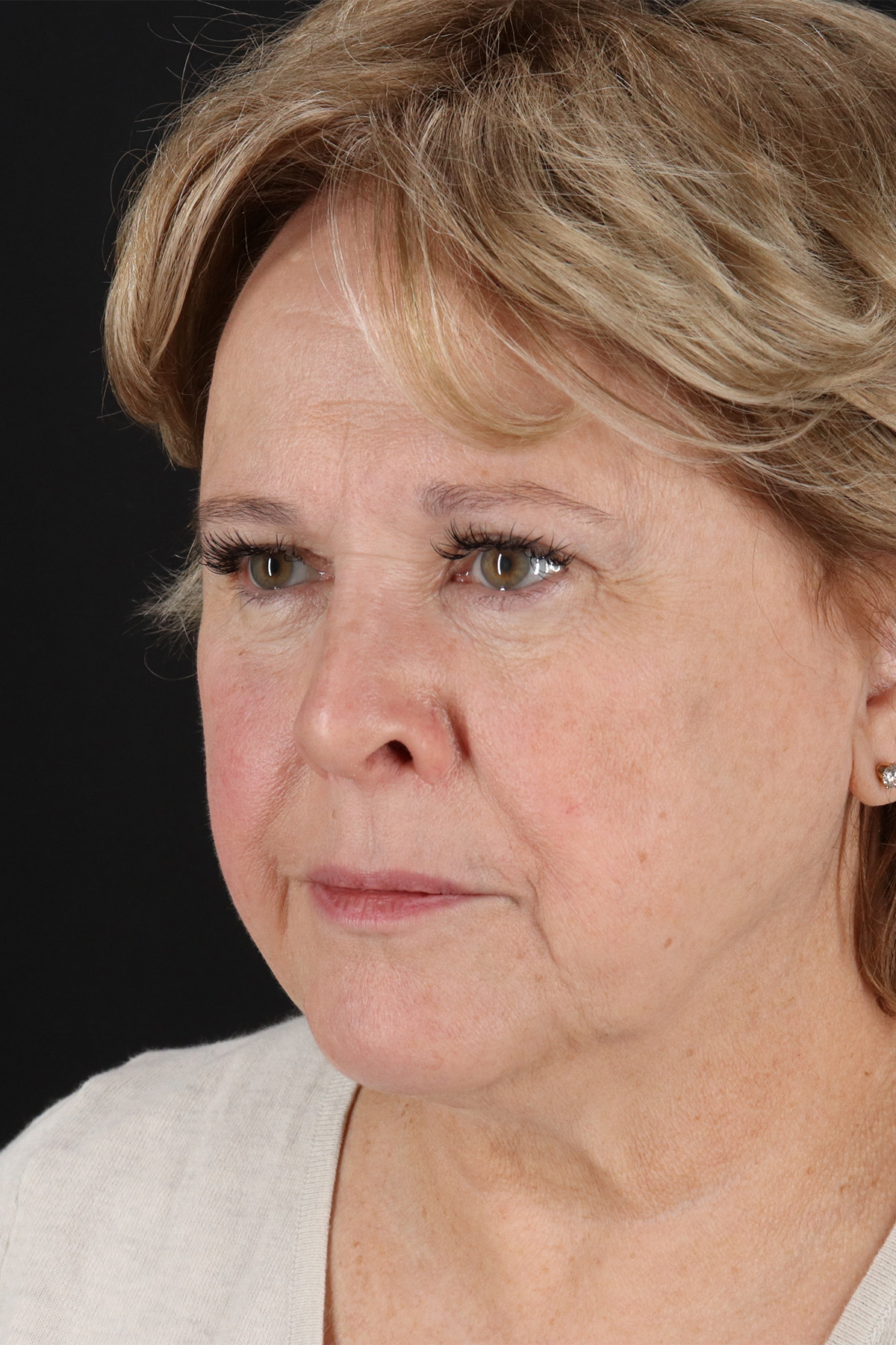 Facelift Before & After Patient #11695