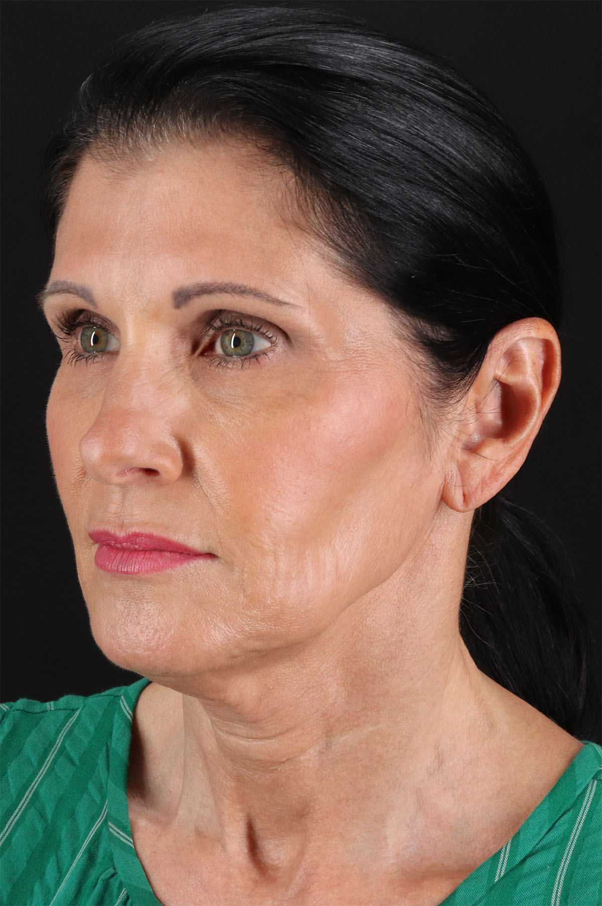 Neck Lift Before & After Patient #12887