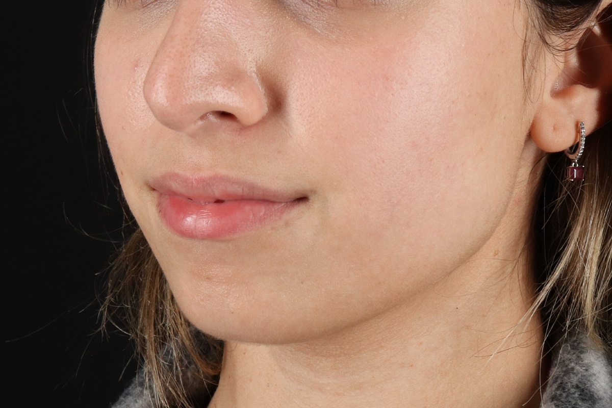 Chin Implant Before & After Patient #13750