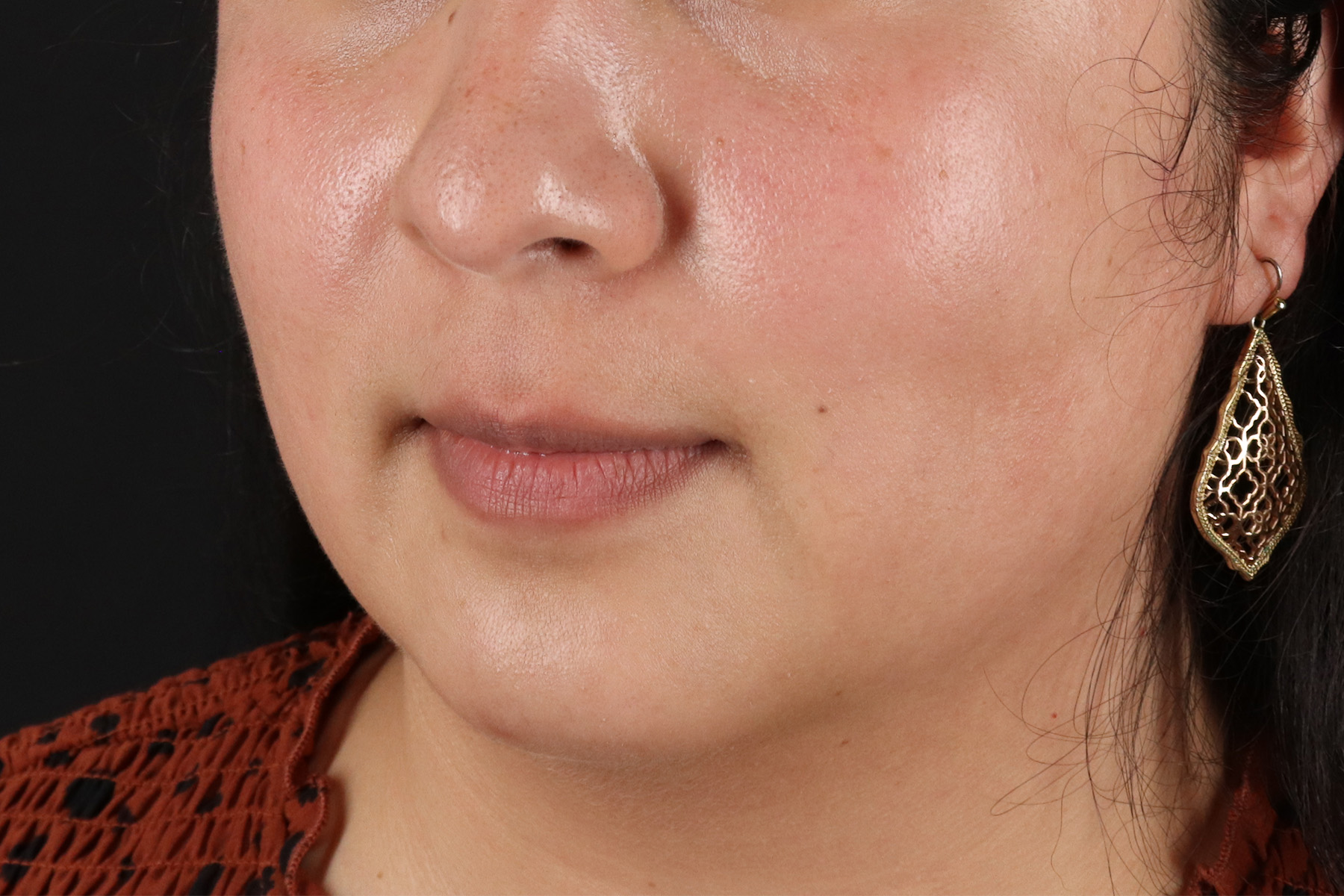 Chin Implant Before & After Patient #13794