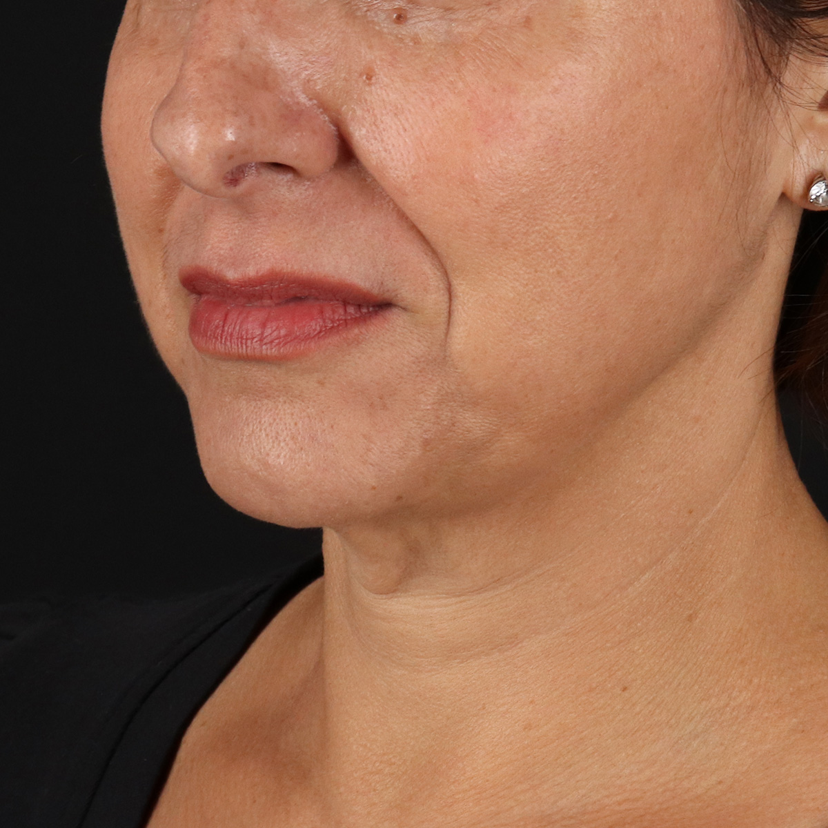 Neck Lift Before & After Patient #12953