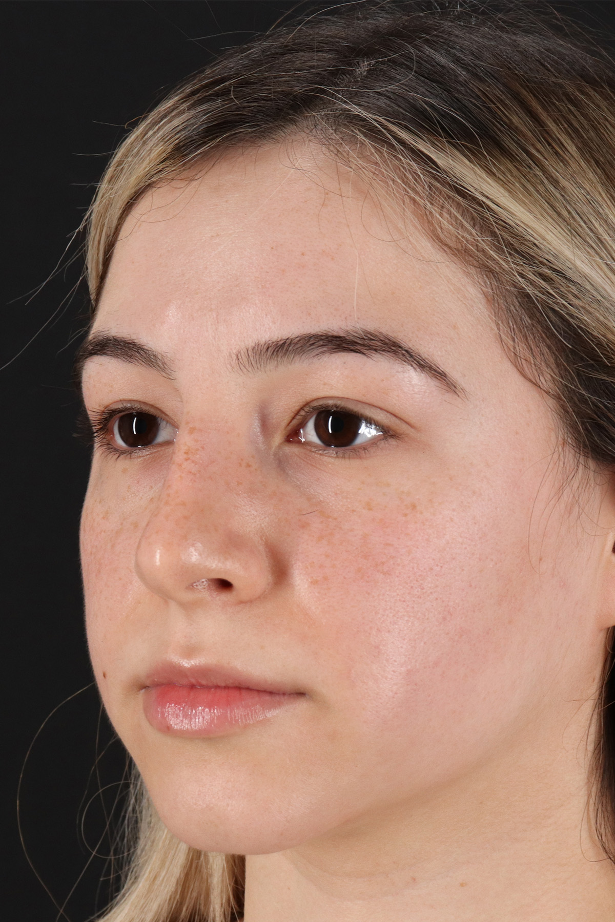Rhinoplasty Before & After Patient #12271
