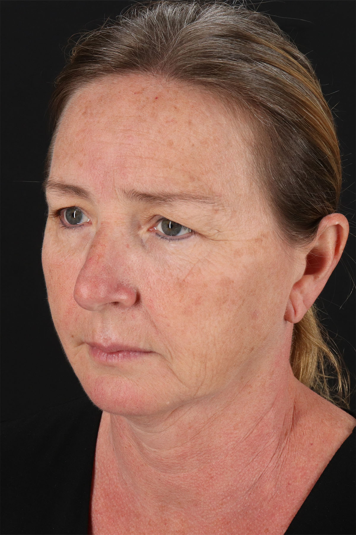 Upper Blepharoplasty Before & After Patient #12040