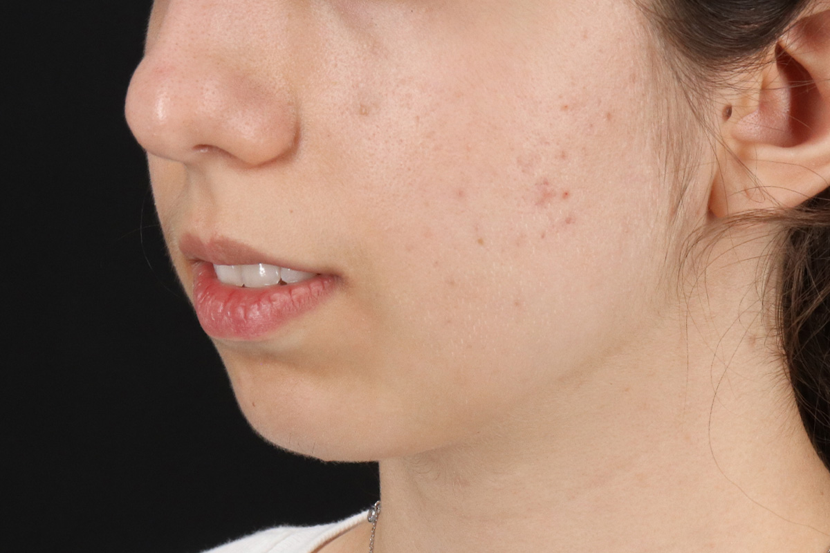 Chin Implant Before & After Patient #13772