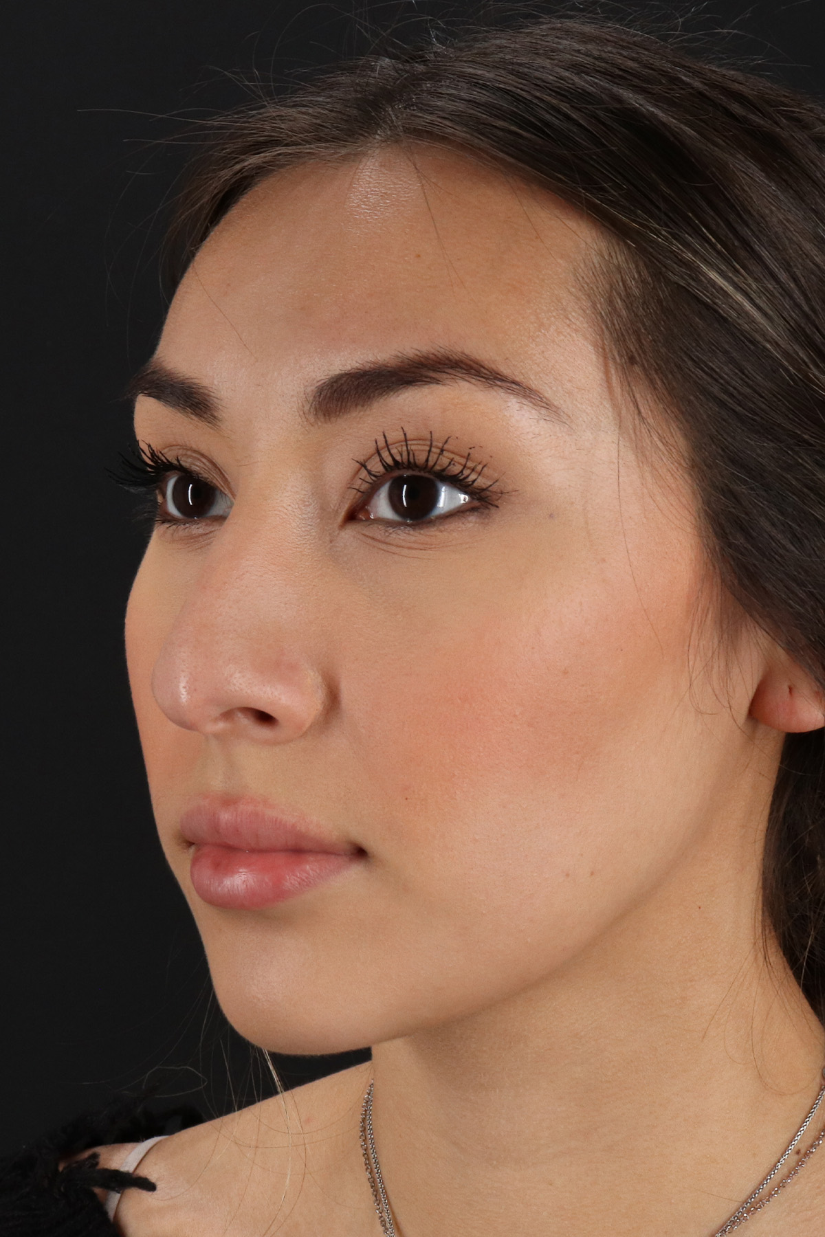 Rhinoplasty Before & After Patient #12480