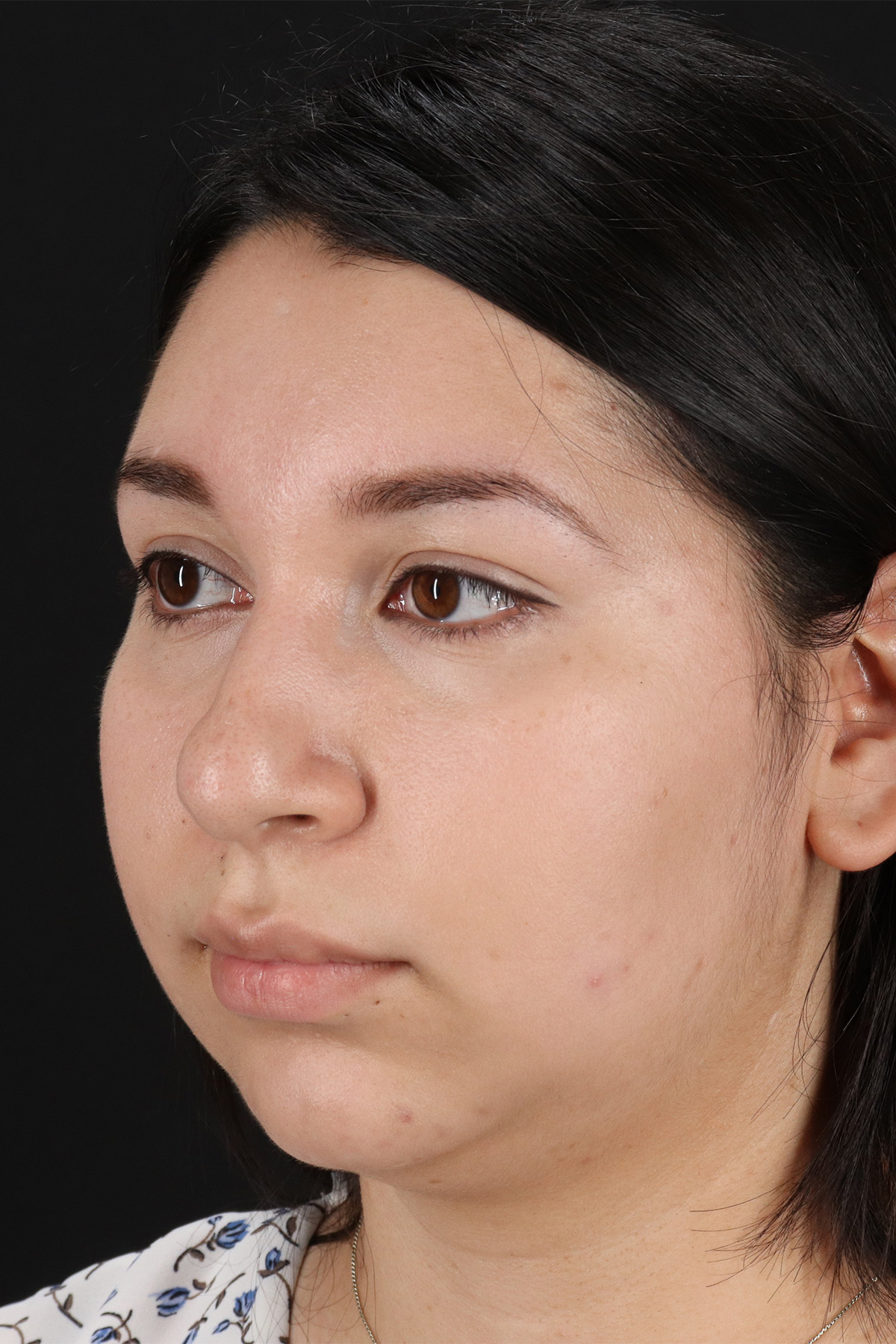 Chin Implant Before & After Patient #13739