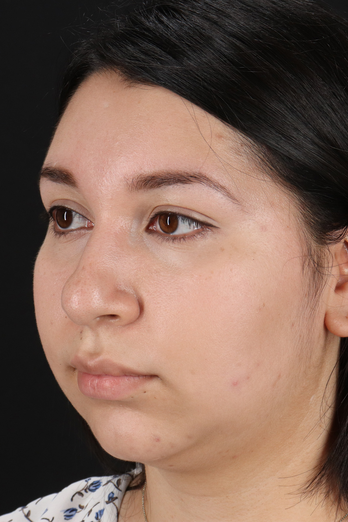 Neck Lift Before & After Patient #11698