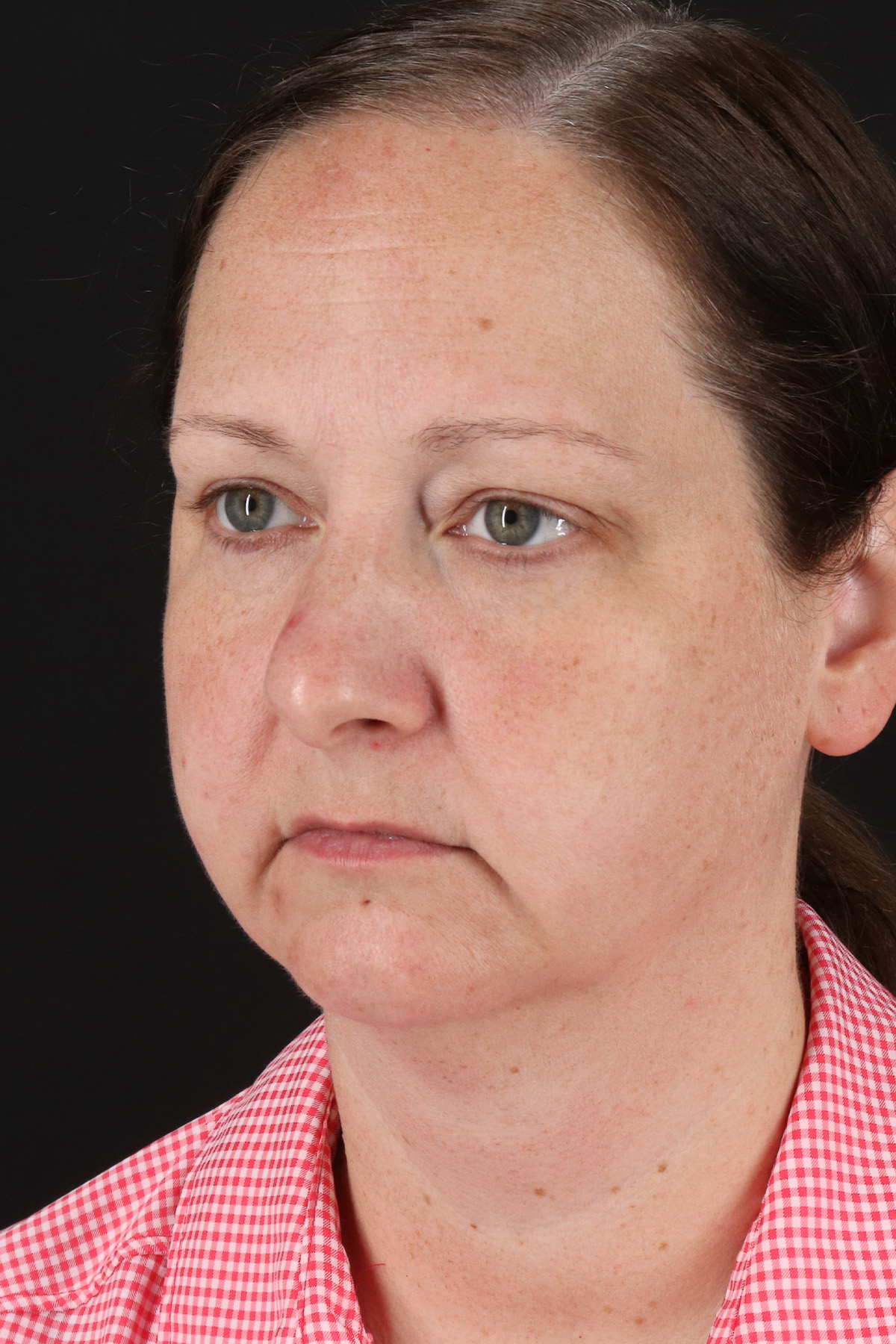 Lower Blepharoplasty Before & After Patient #13052