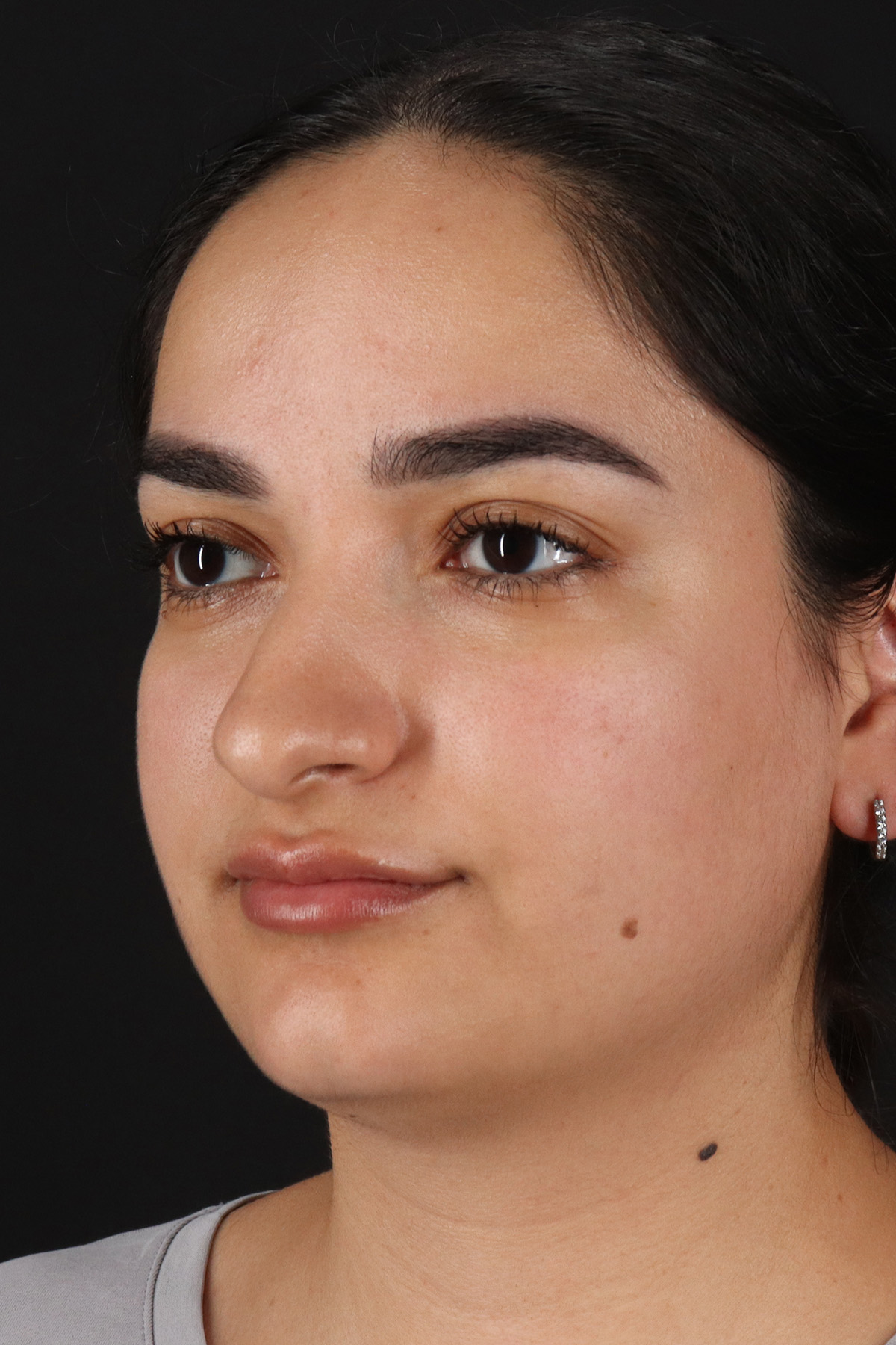 Rhinoplasty Before & After Patient #12436