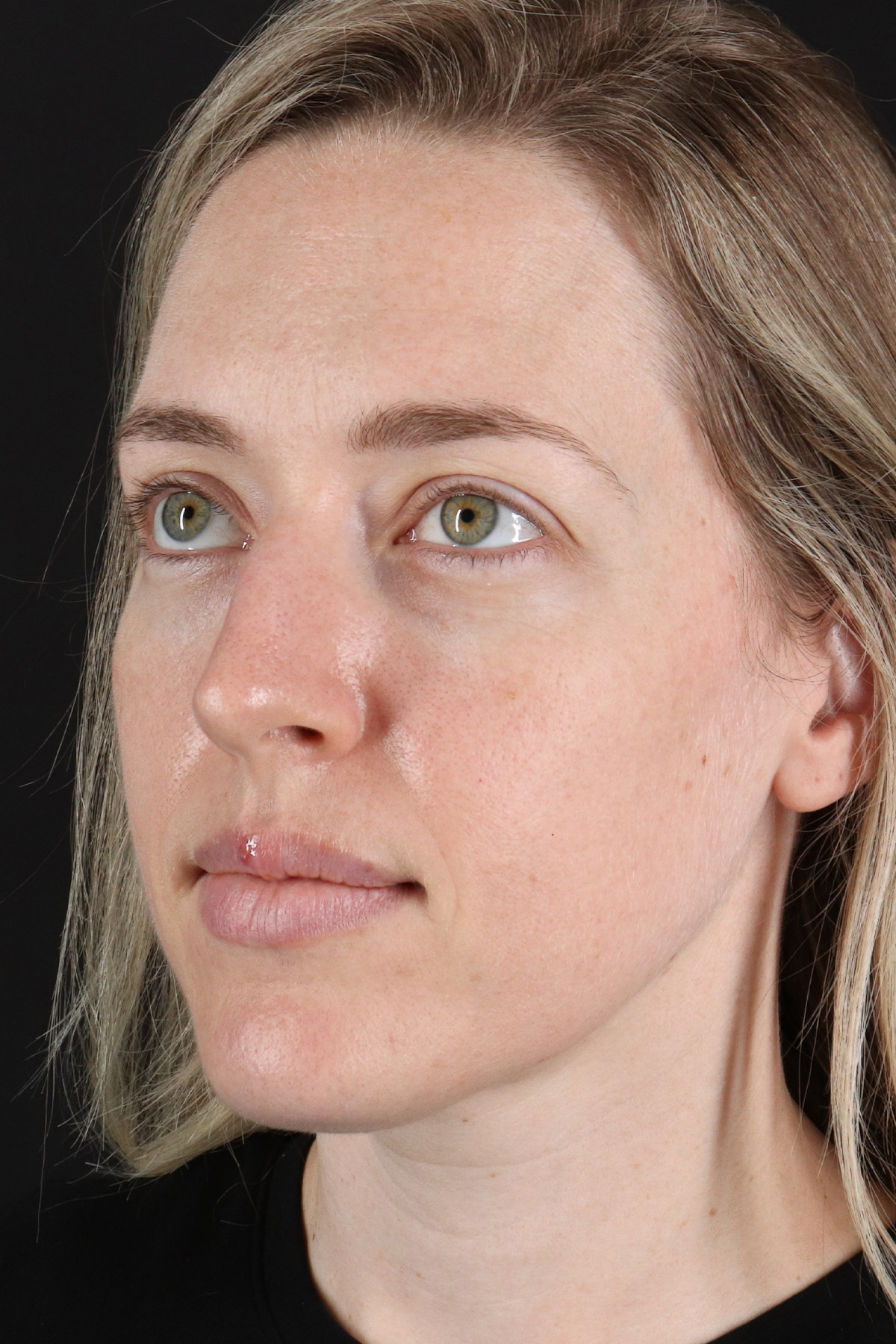 Rhinoplasty Before & After Patient #12227