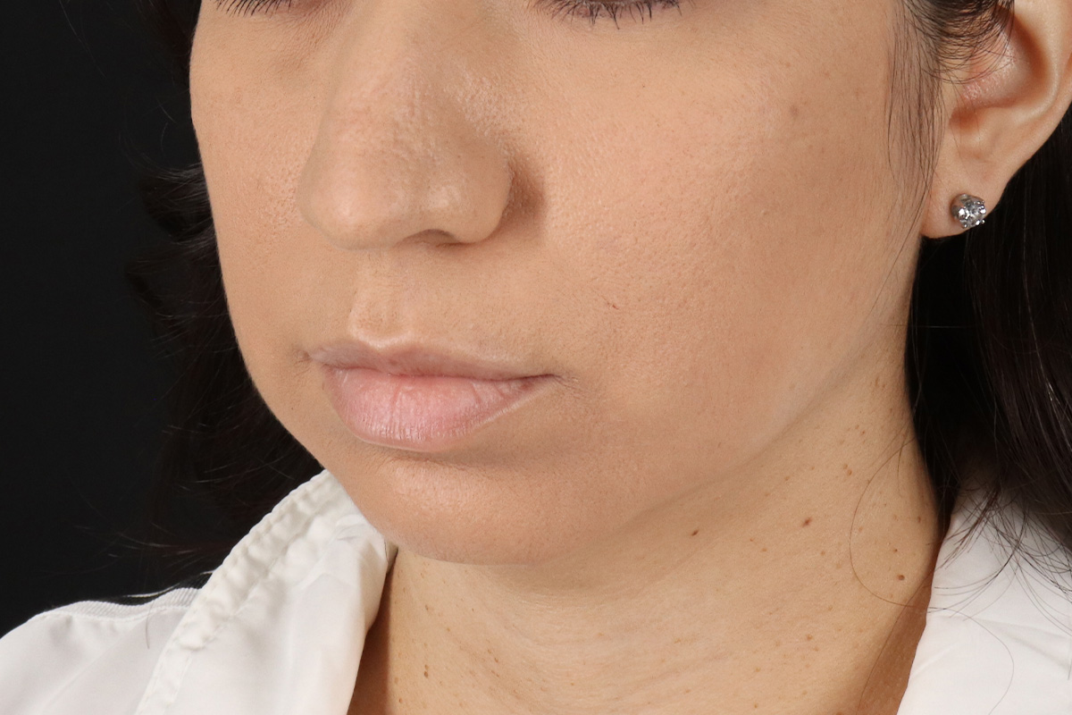 Chin Implant Before & After Patient #13783