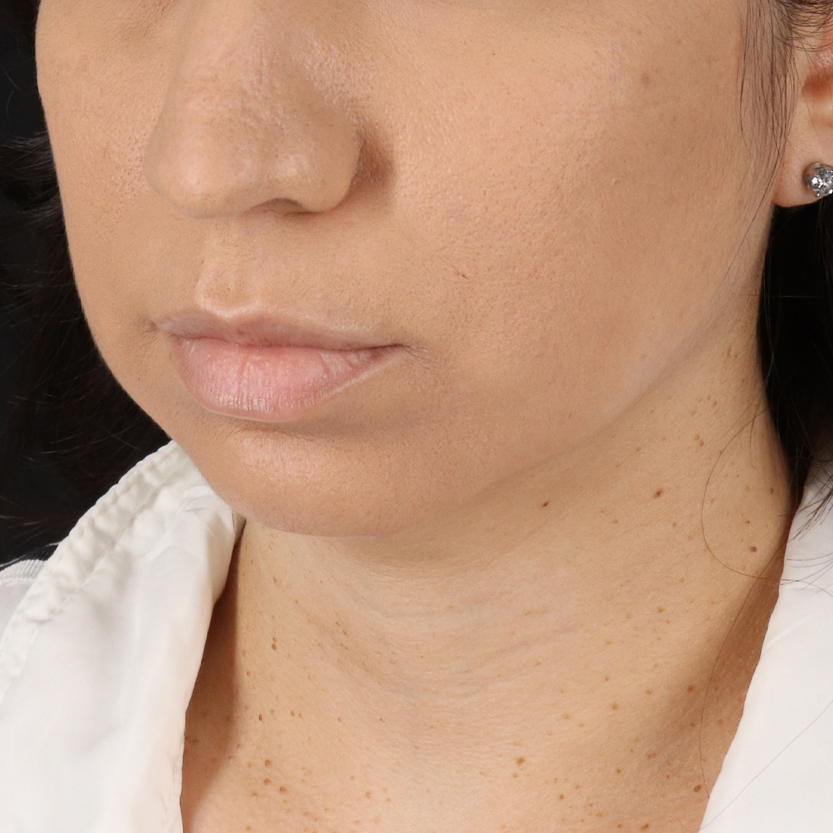 Facelift Before & After Patient #11699