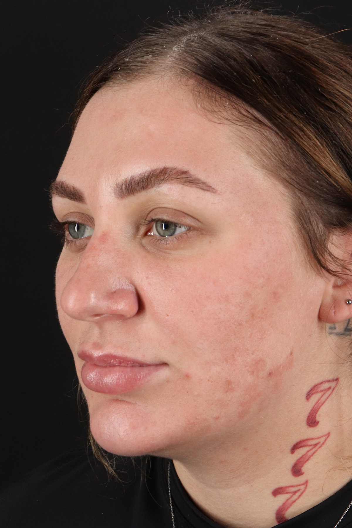 Rhinoplasty Before & After Patient #12403