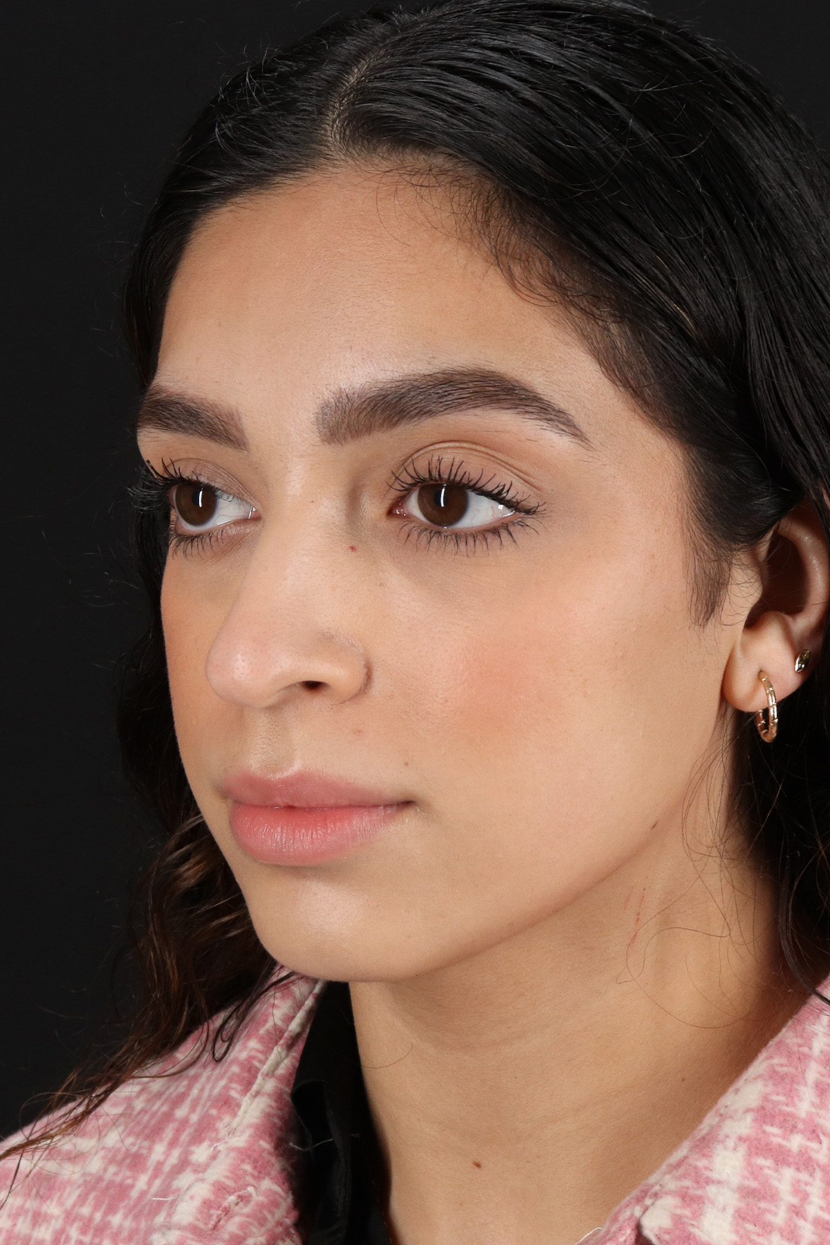 Rhinoplasty Before & After Patient #12249