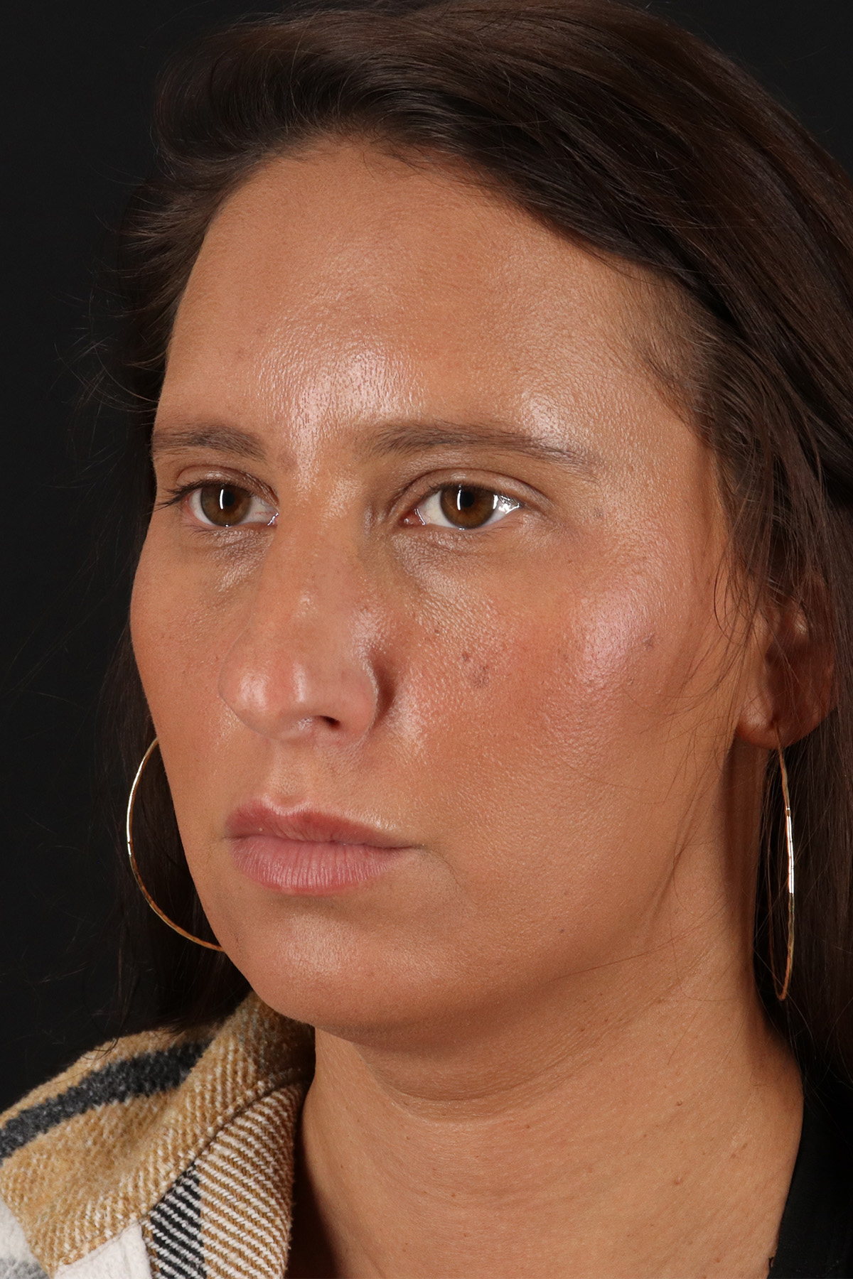 Chin Implant Before & After Patient #13728