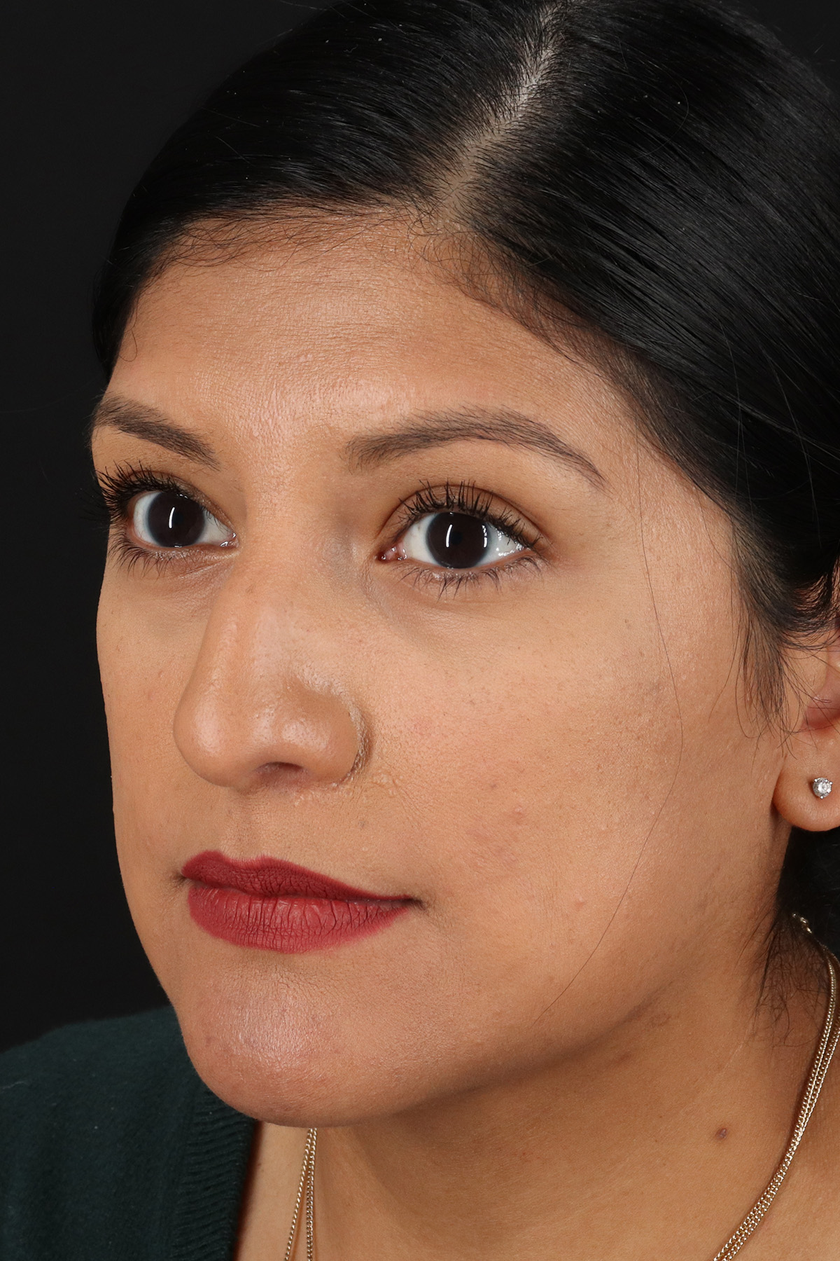 Rhinoplasty Before & After Patient #12337