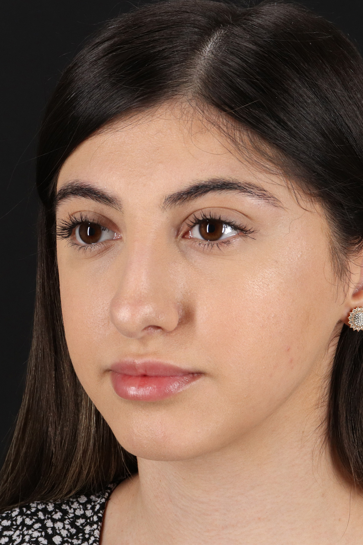 Rhinoplasty Before & After Patient #12304