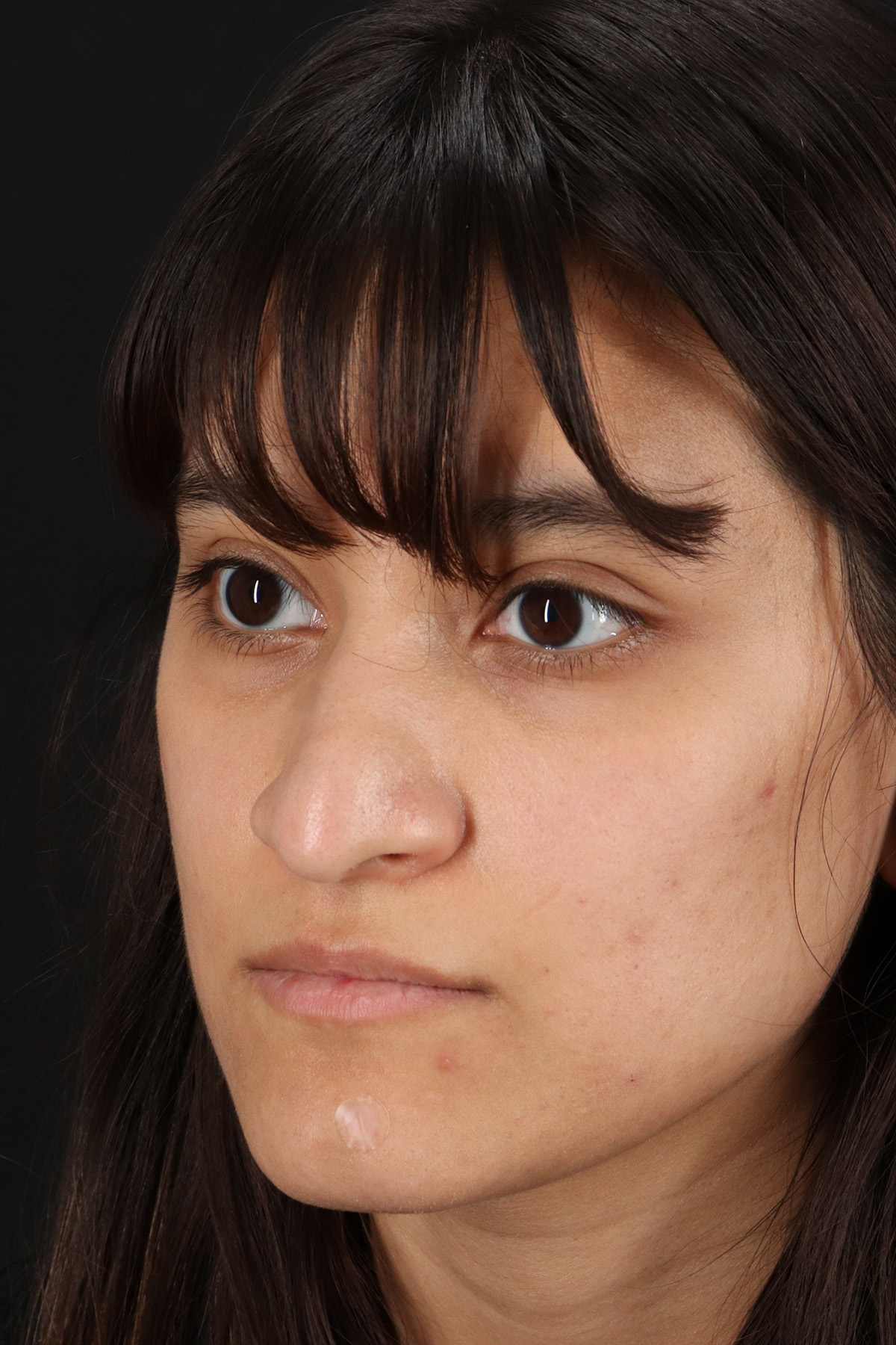 Rhinoplasty Before & After Patient #12469