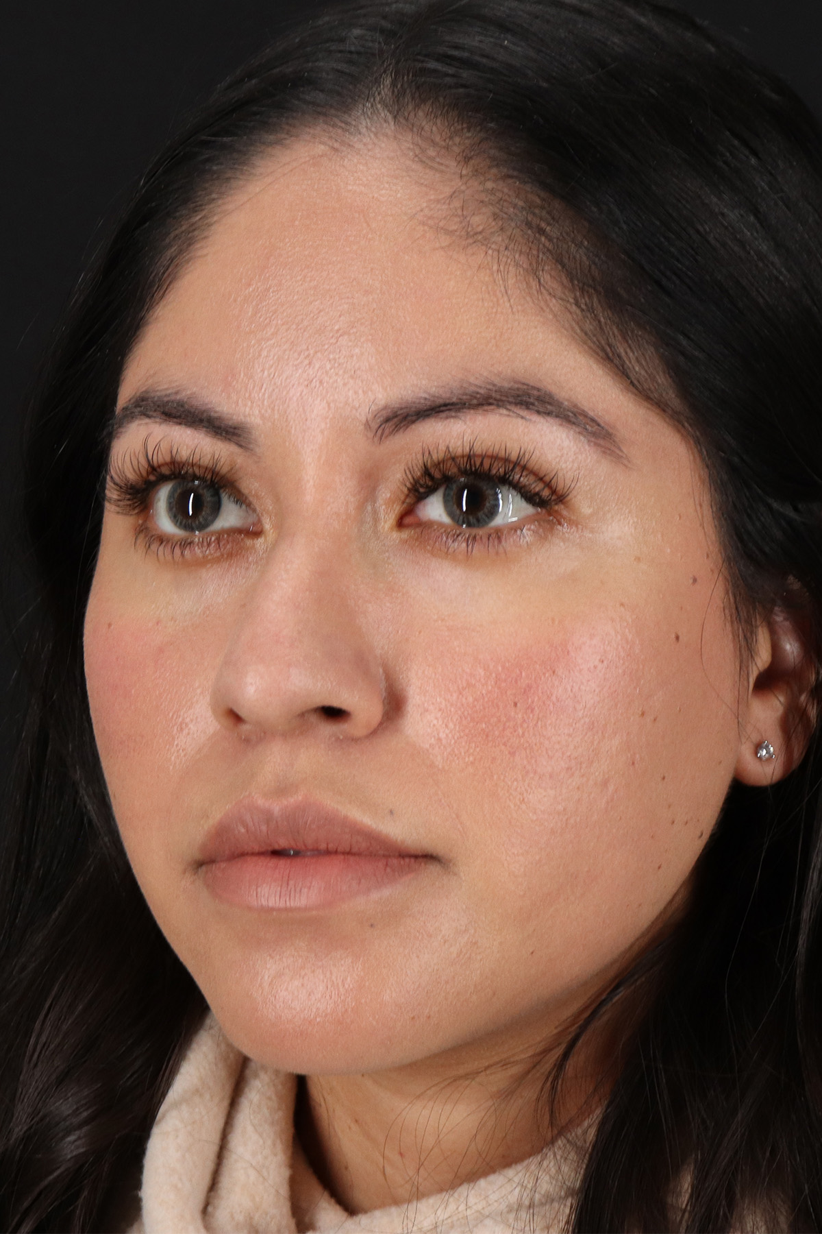 Fillers Before & After Patient #13276