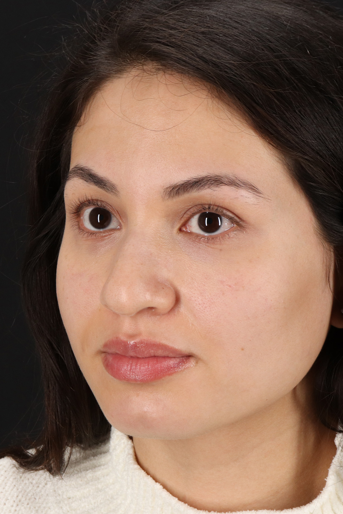 Rhinoplasty Before & After Patient #12282