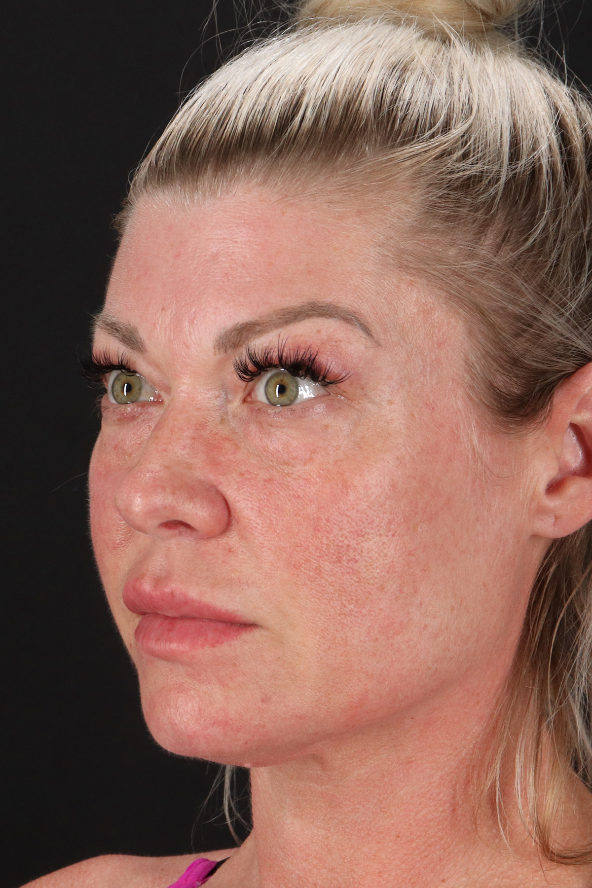 Lower Blepharoplasty Before & After Patient #13030