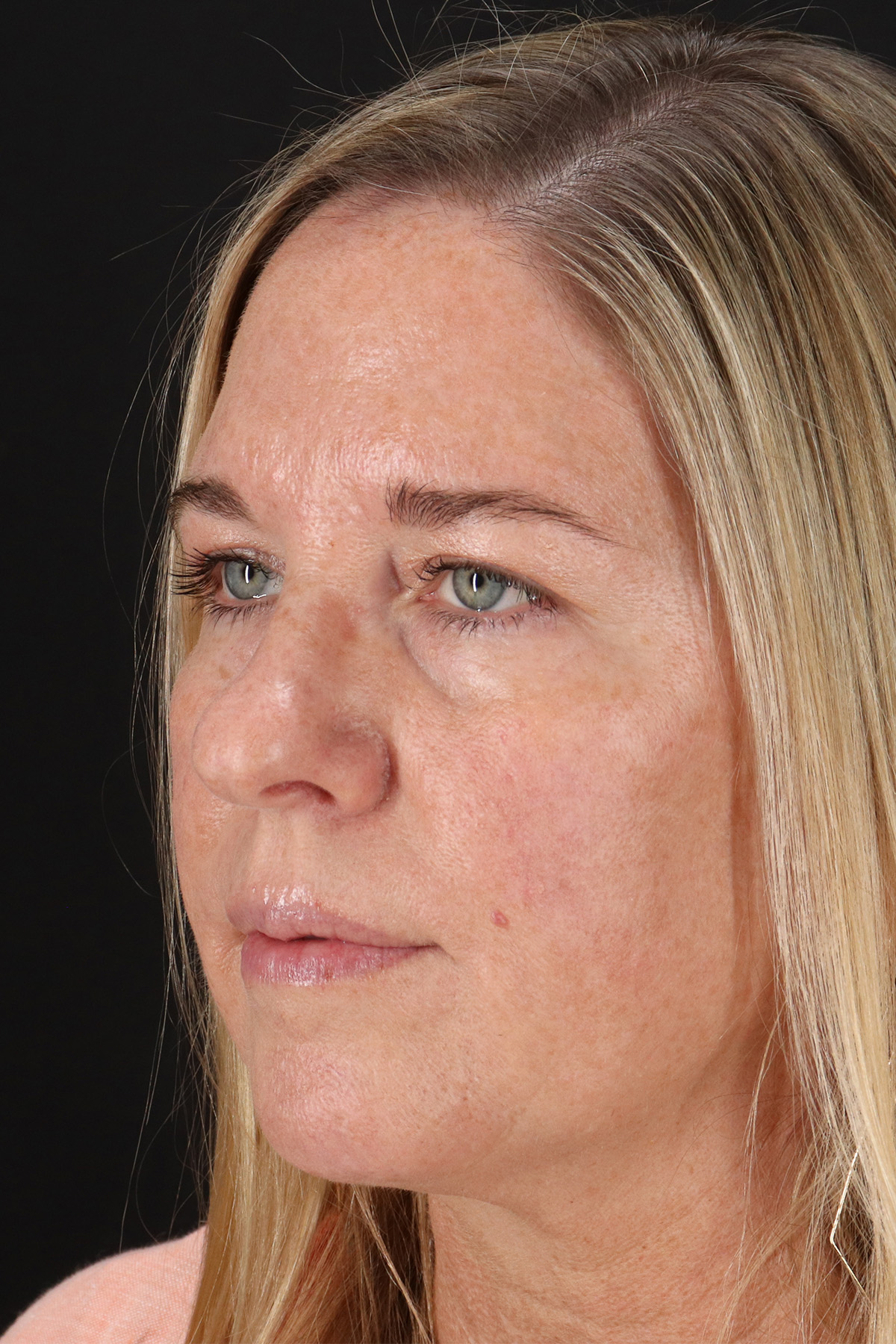 Rhinoplasty Before & After Patient #12194