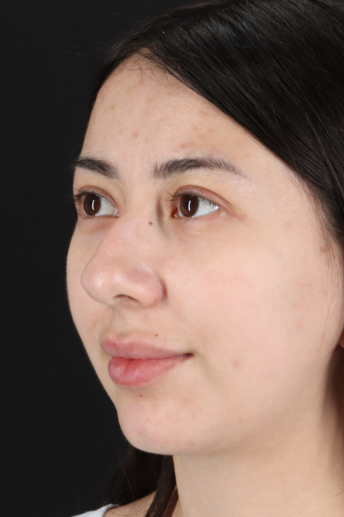 Rhinoplasty Before & After Patient #12359