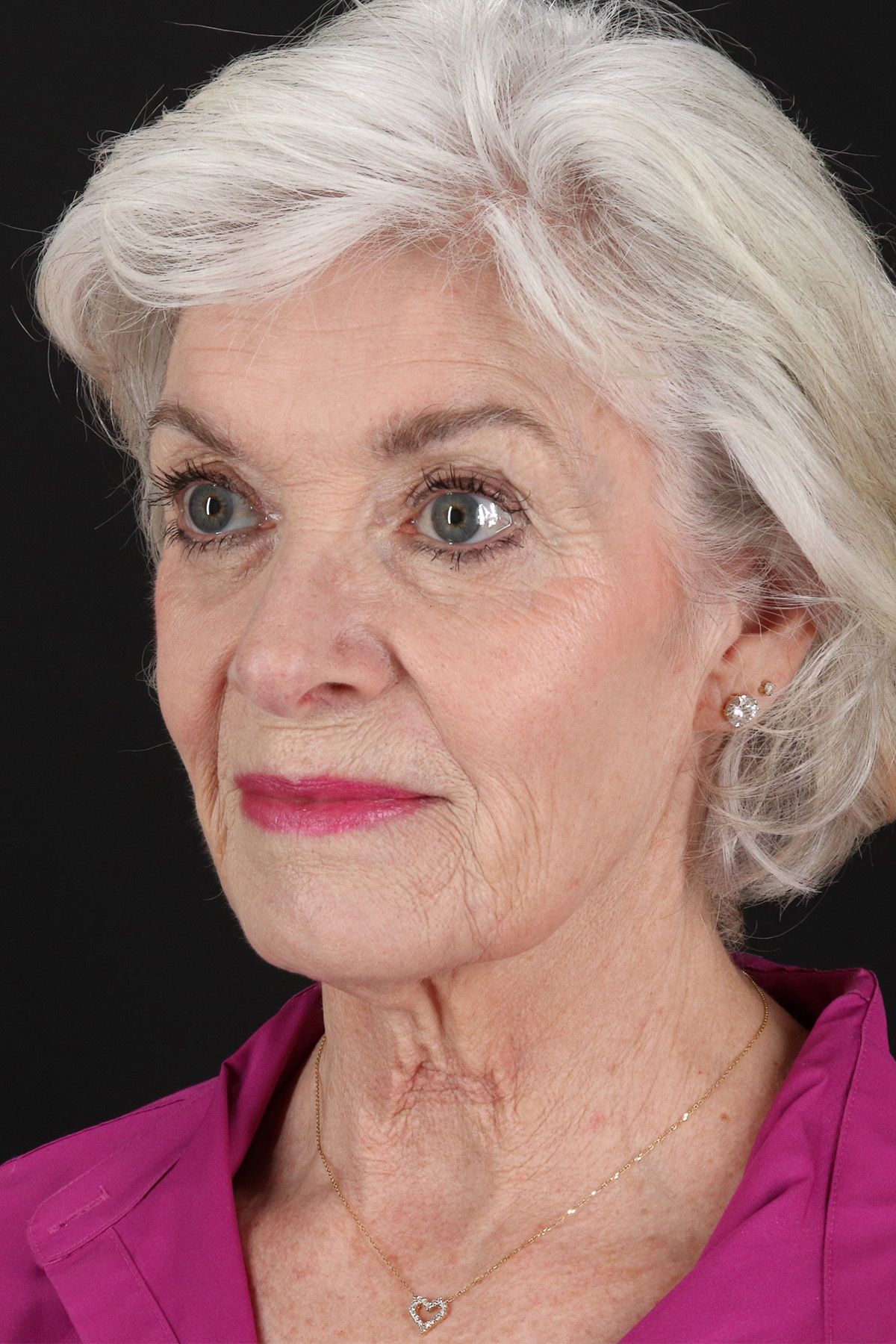 Upper Blepharoplasty Before & After Patient #14036