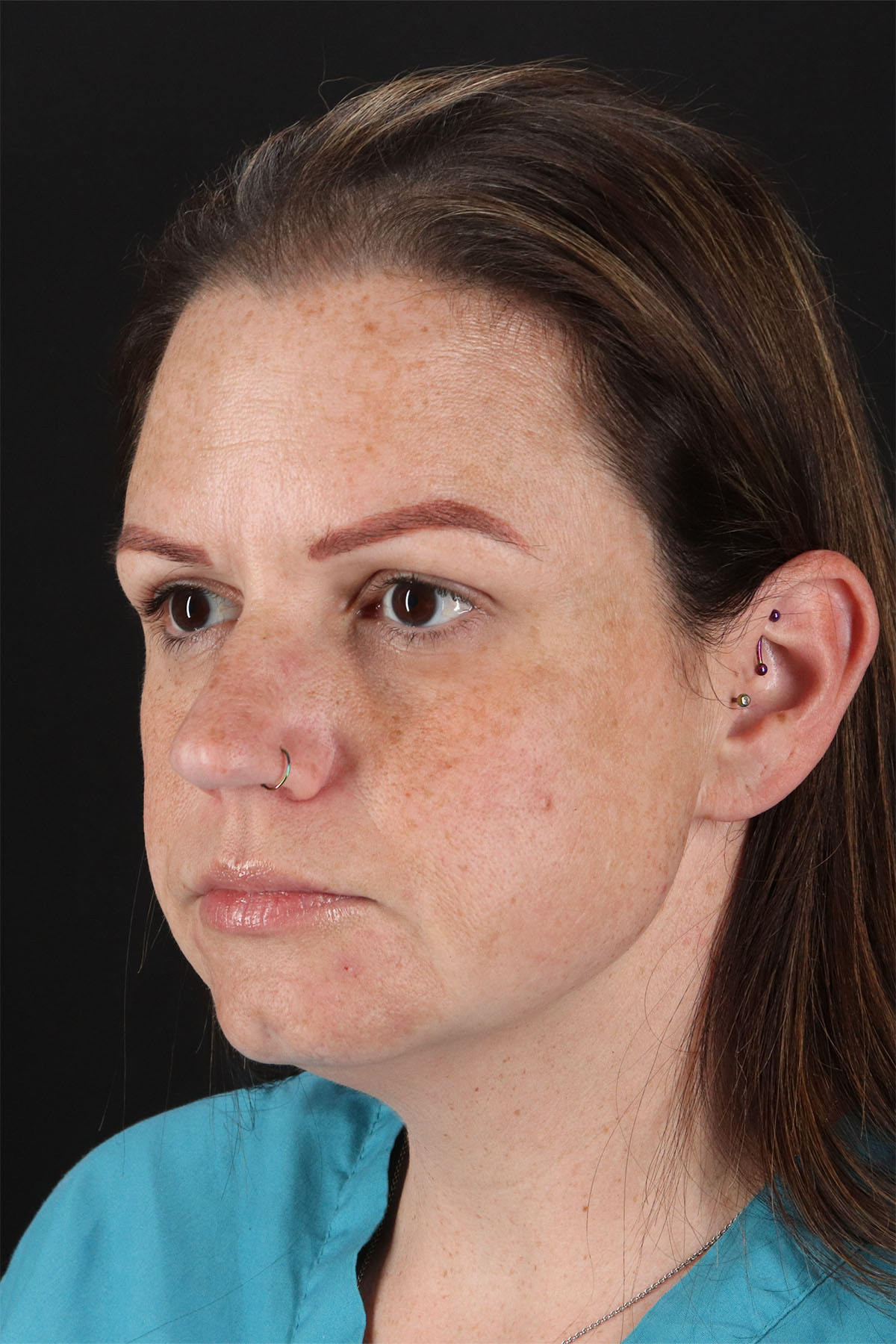 Chemical Peels Before & After Patient #11070