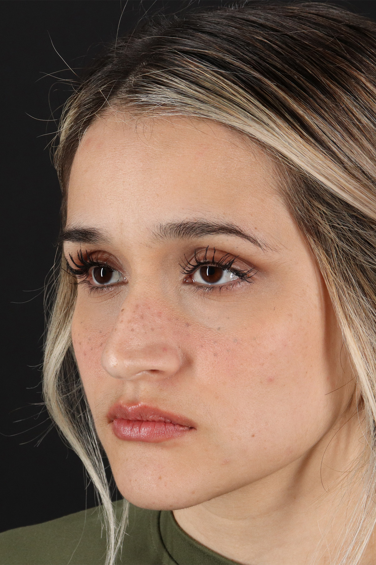 Rhinoplasty Before & After Patient #12260