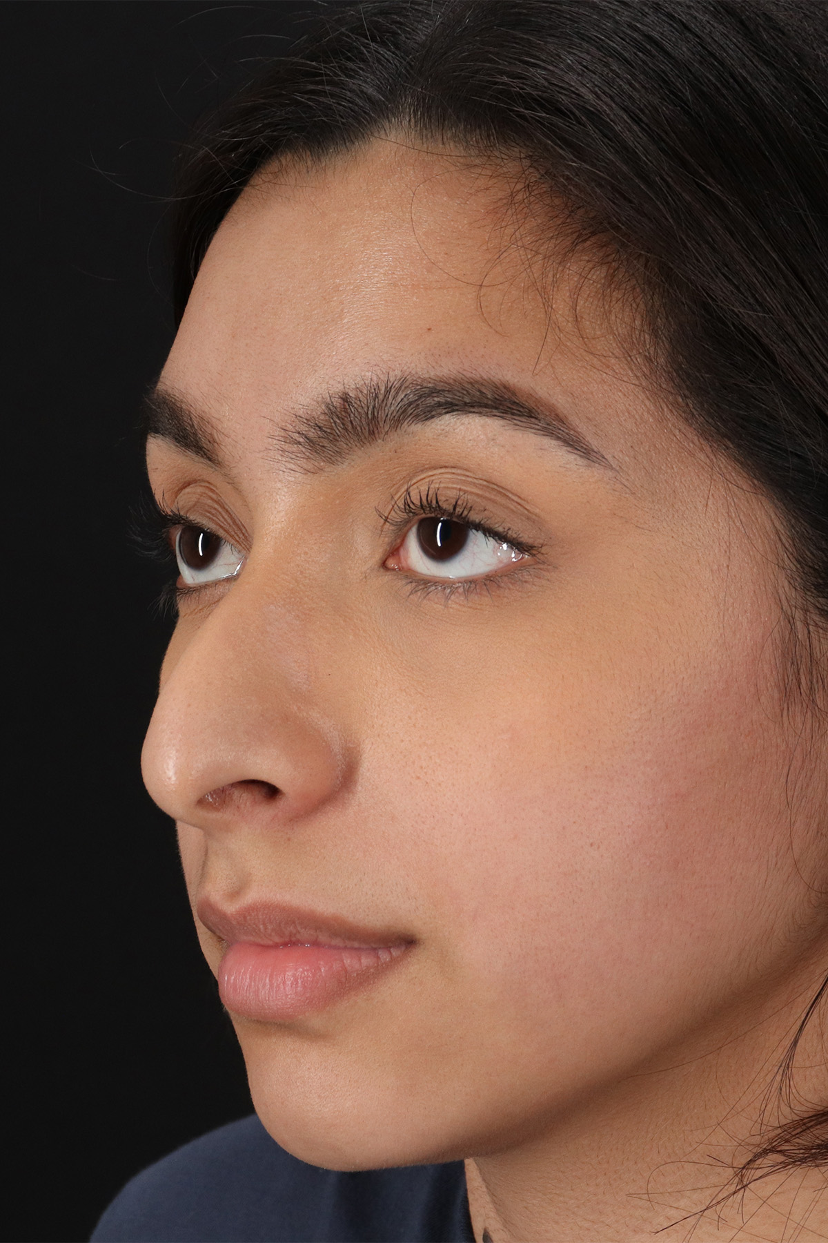 Chin Implant Before & After Patient #13706