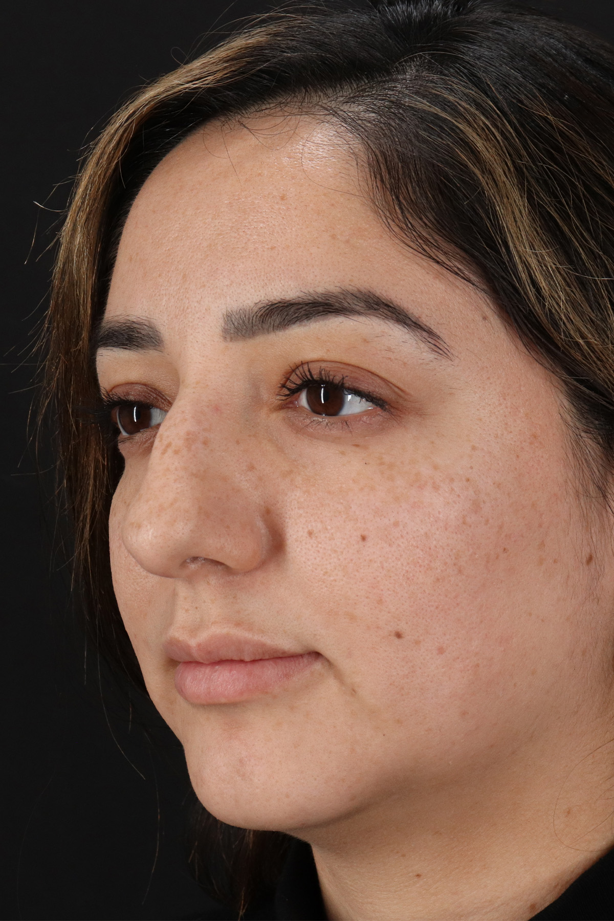 Rhinoplasty Before & After Patient #12392