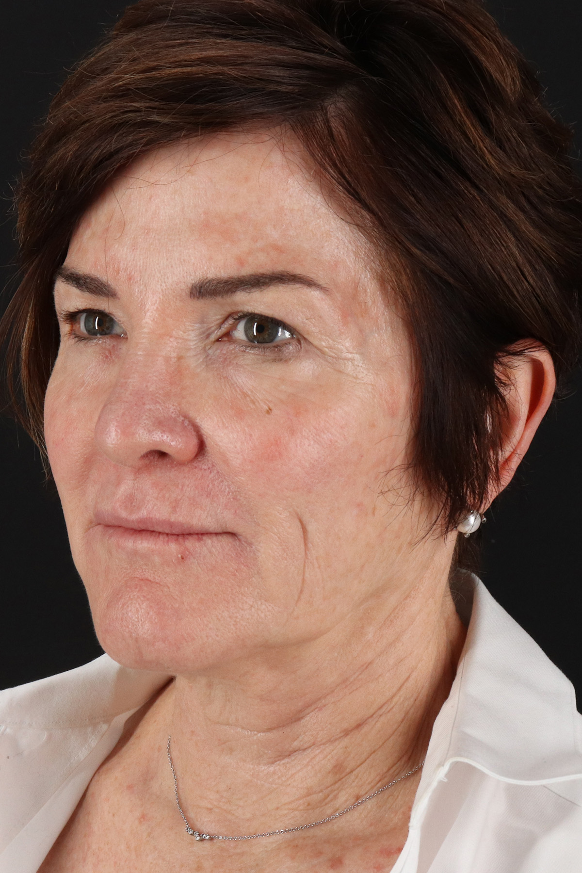 Facelift Before & After Patient #10815