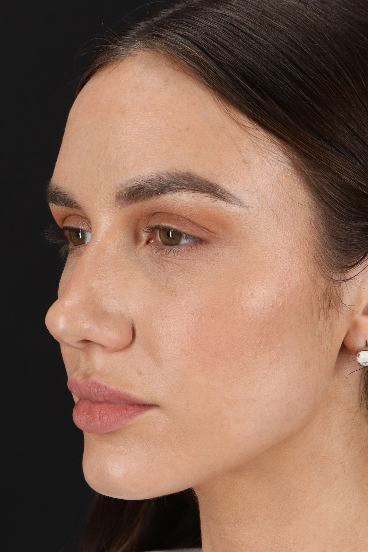 Rhinoplasty Before & After Patient #12370