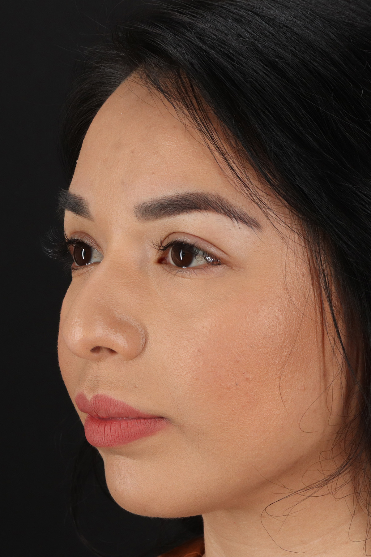 Chin Implant Before & After Patient #13717