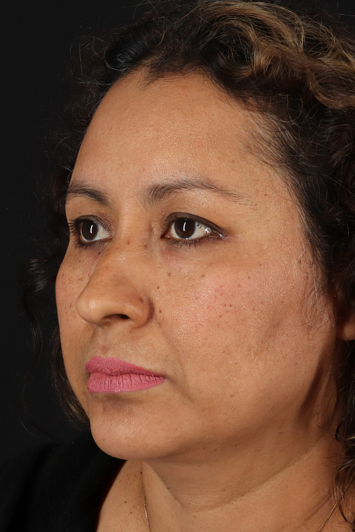 Rhinoplasty Before & After Patient #12293