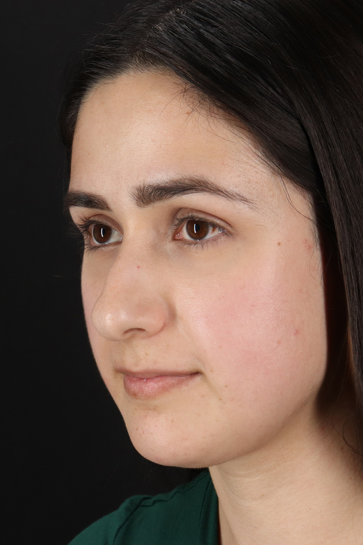 Liquid Rhinoplasty Before & After Patient #11339