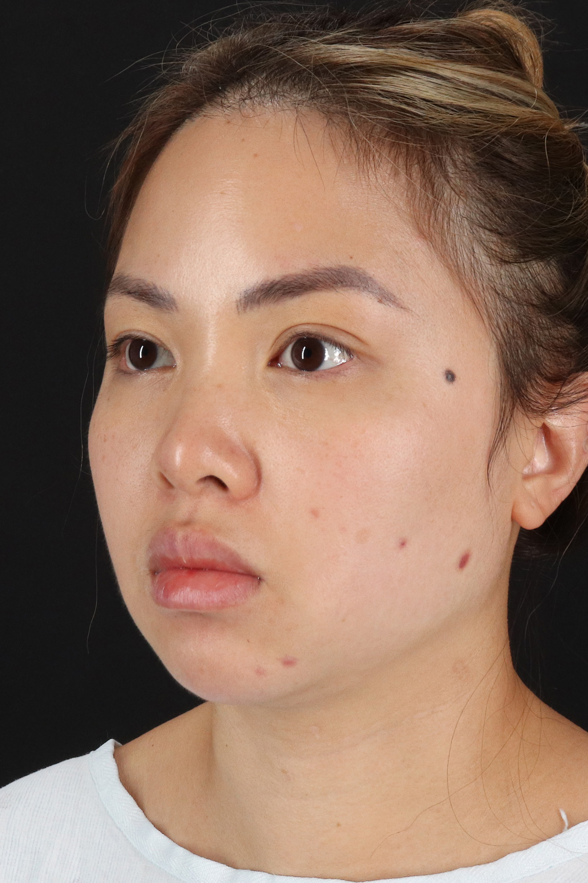 Chin Implant Before & After Patient #13816