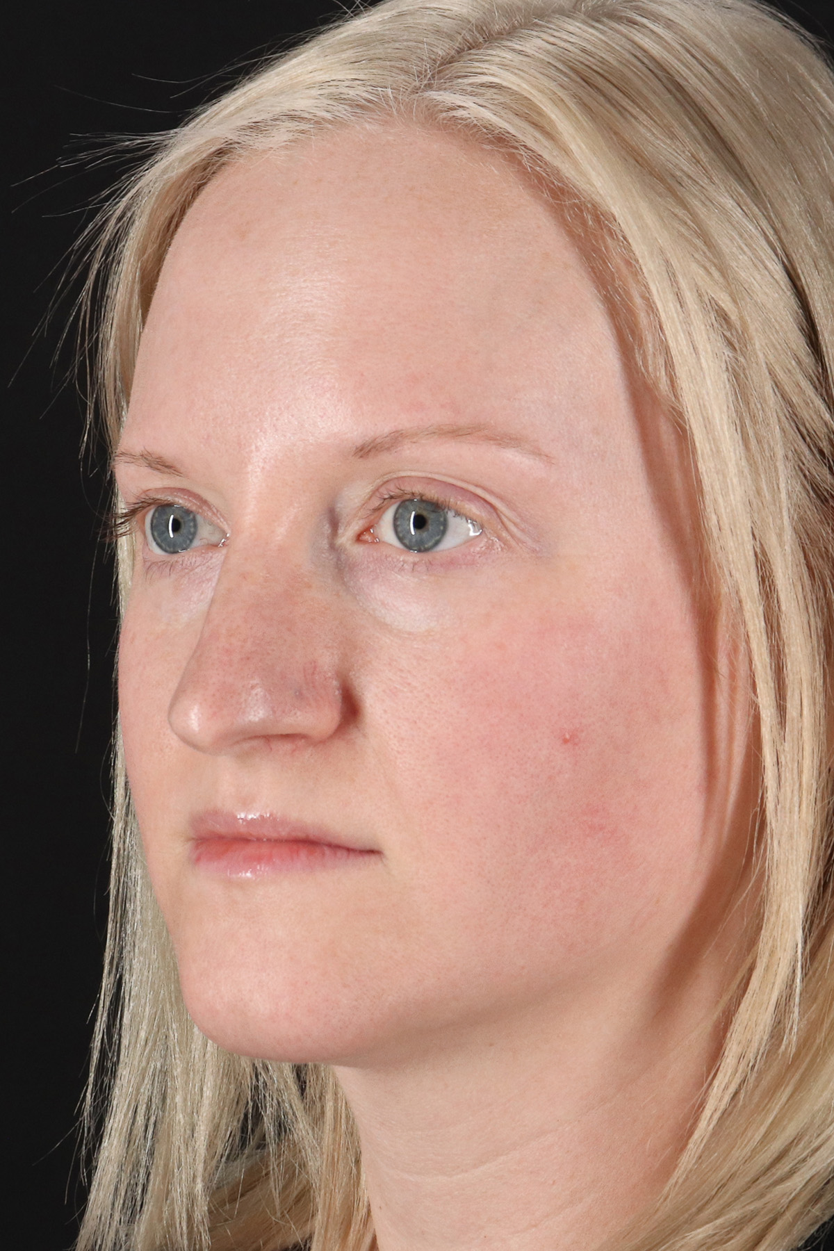 Rhinoplasty Before & After Patient #12381