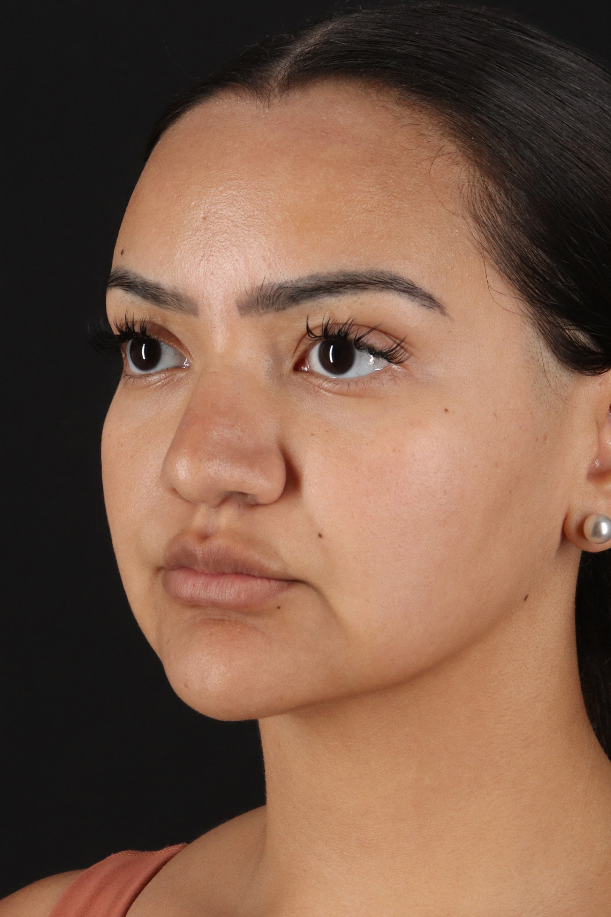 Rhinoplasty Before & After Patient #12326
