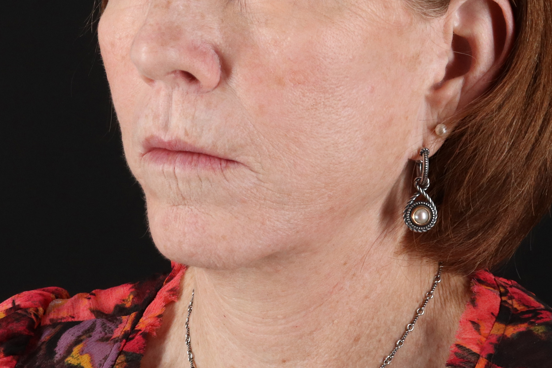 Neck Liposuction Before & After Patient #12117