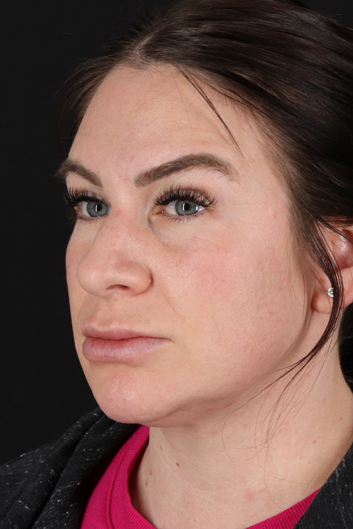 Rhinoplasty Before & After Patient #12414