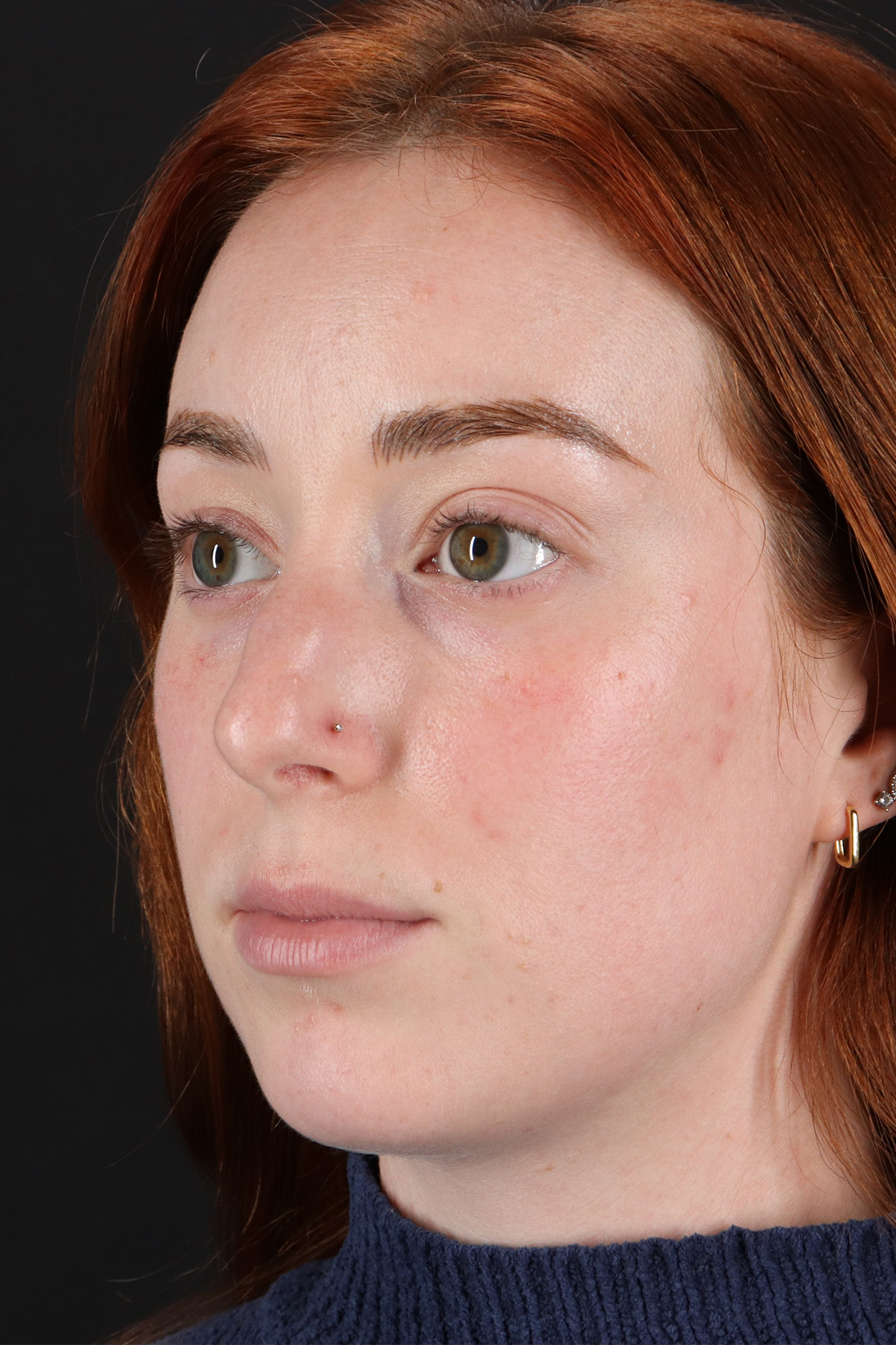 Rhinoplasty Before & After Patient #12348