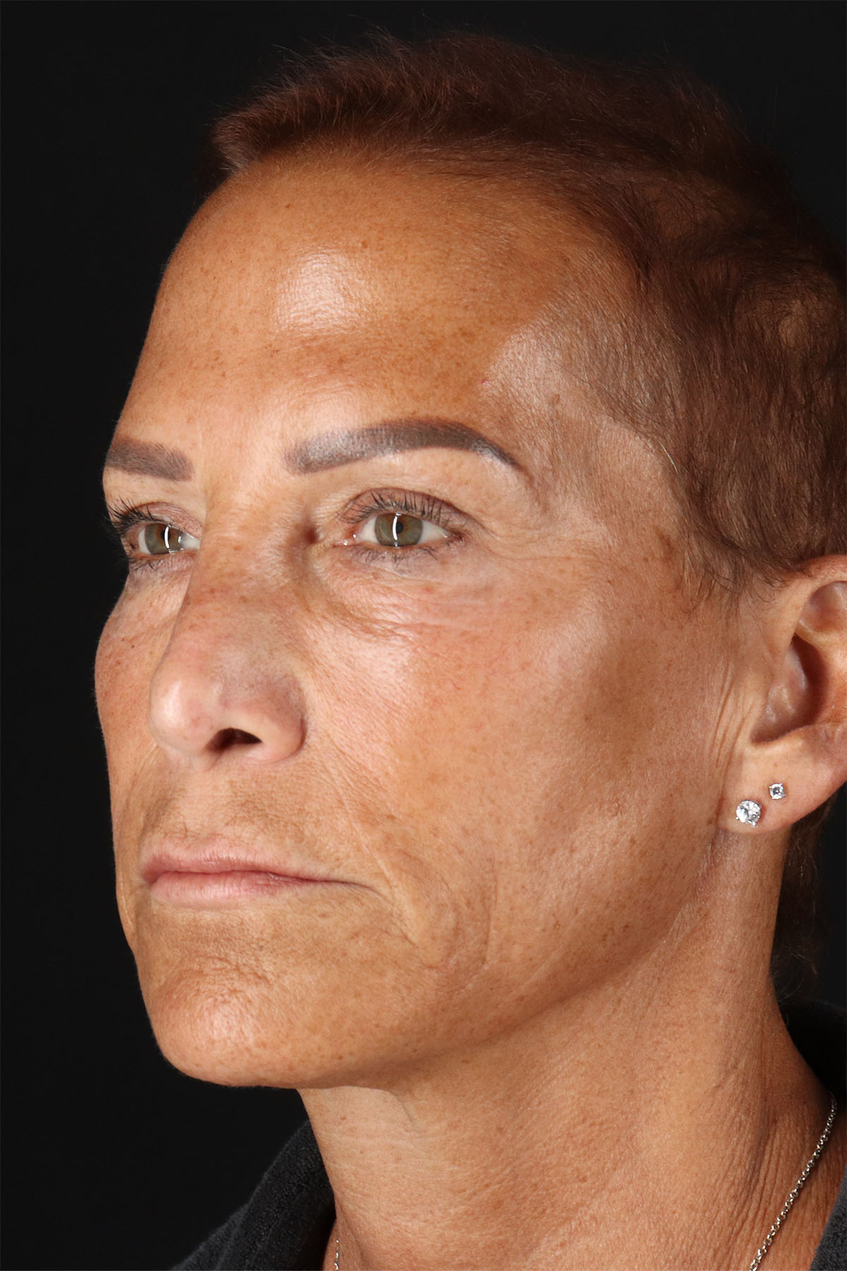 CO2 Laser Before & After Patient #10980