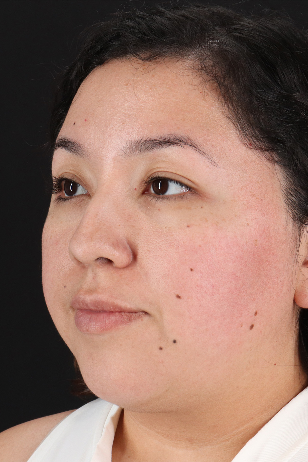 Rhinoplasty Before & After Patient #12447