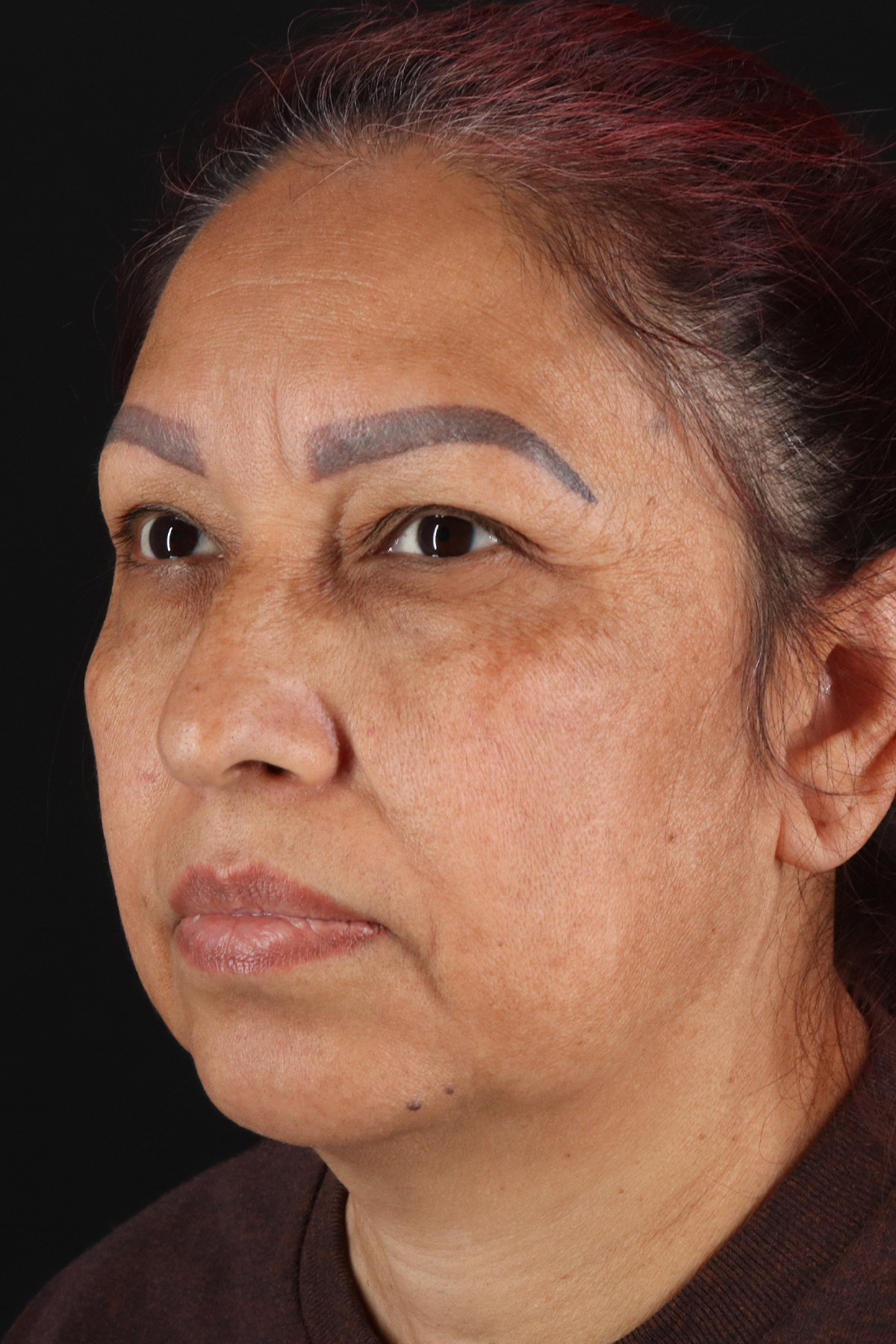 Upper Blepharoplasty Before & After Patient #12051